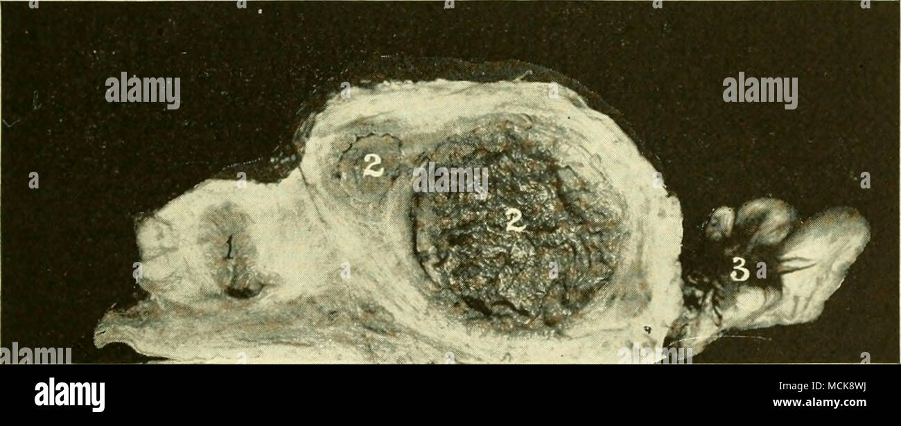 Fig. 197-cervicale abcès. /, De l'utérus ; . ?, abcès ; j. l'hydrosalpinx,  pellicule mince de cellules mortes est perturbée, une guérison rapide,  reste en surface. Une deuxième application peut être