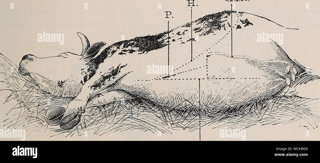 . L3. Fig. 178.-siège d'opération pour ponction du péricarde par ensiform^ le cartilage. L B, AVhite ; la ligne H, la ligne de l'hypochondre ; Y.M.une veine mammaire antérieure., ; P, point où le péricarde est percé à travers l'incision. muscles pectoraux attachées au collier du ensiform cartilage peut alors être divisée par le bistouri. La zone d'opérations est donc découvert. Deuxième étape. La deuxième phase comprend l'incision des tissus mous en face du col de l'ensiform cartilage, environ 8 pouces à l'avant de la base du triangle et à égale distance des points nos 1 et Banque D'Images