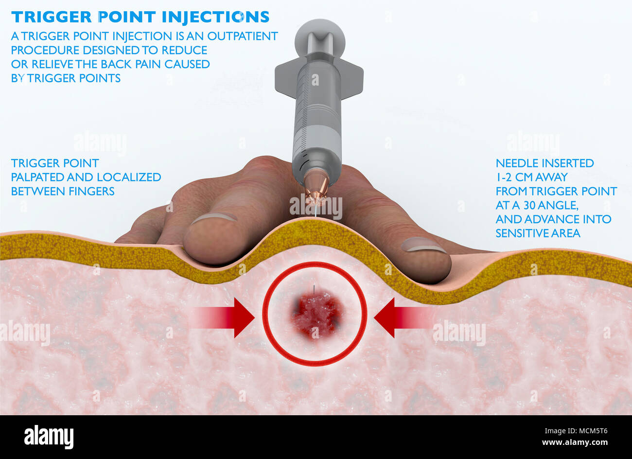 Un point de déclenchement injection est un procédé visant à réduire ou à soulager les maux de dos causés par des points de déclenchement. L'injection intramusculaire Banque D'Images
