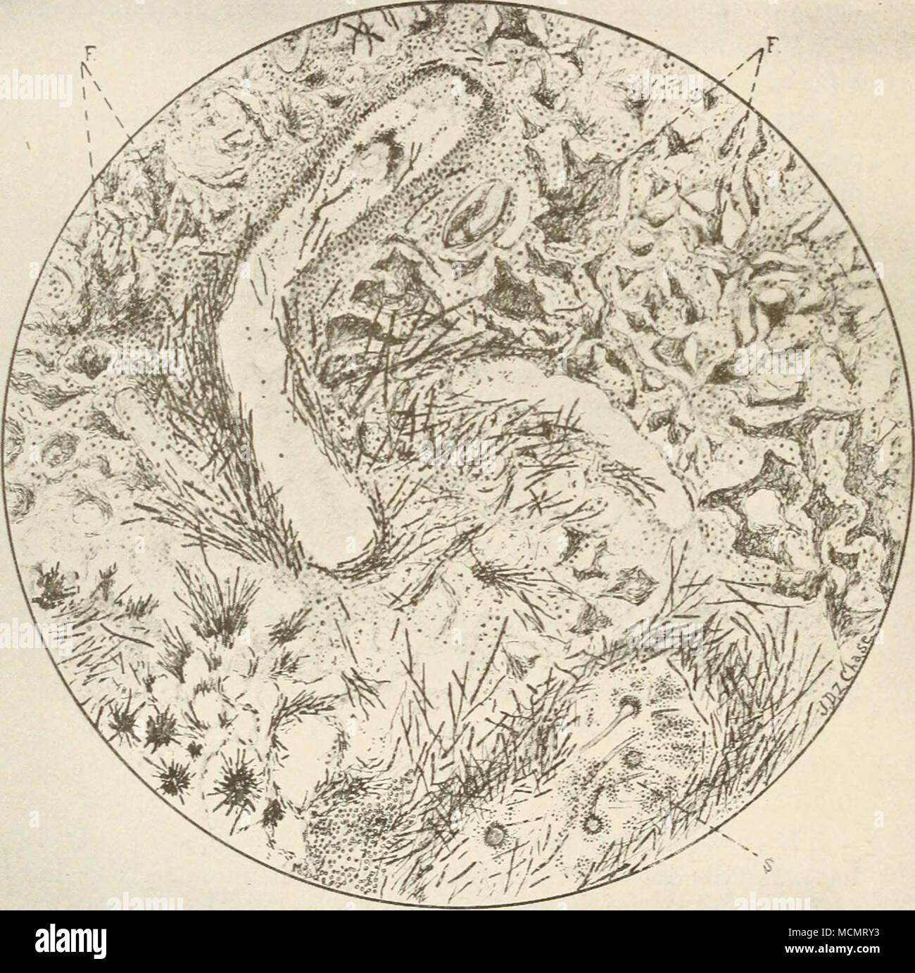 . Fig. 87. Drazving composite de l'article de nodules pulmonaires par l'intermédiaire d'origine aspergillus. F, en fibrine alvéoles. S, fruits des hyphes et des spores de champignon (Ravenel). à la plage de sons de percussion. Au moment de l'auscultation, il a été constaté que le murmure vésiculaire et bronchiques ont été envisager- Banque D'Images