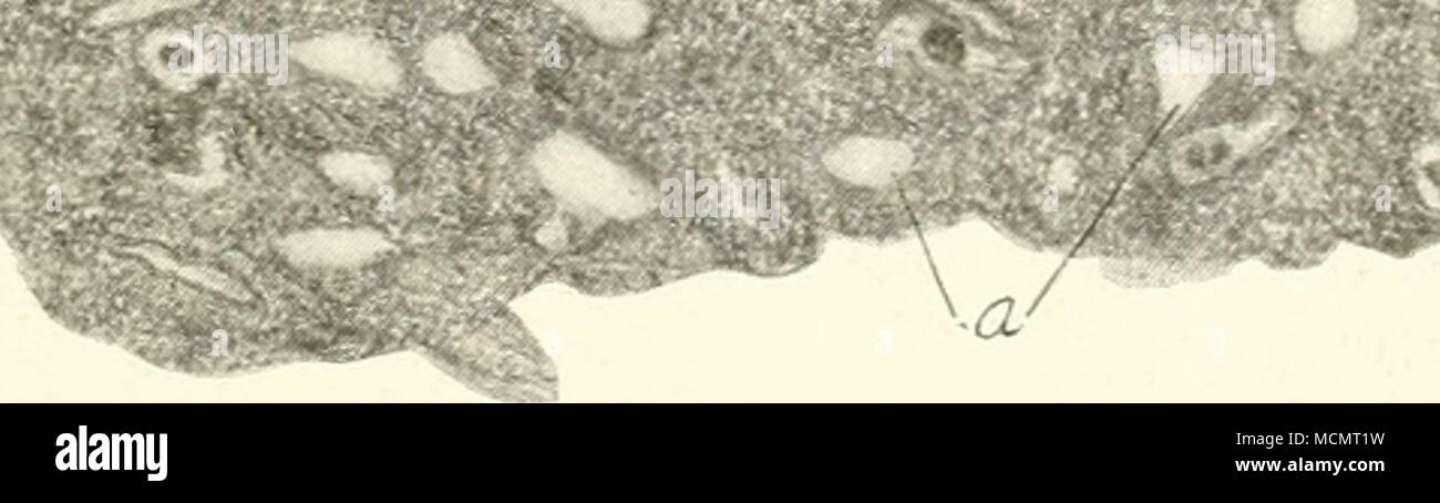 . Fig. 27. Drazving d'un poumon de la morve du cheval contenant des nodules (&Lt ; ?). Ils apparaissent à la fois sur l'épanchement et les surfaces coupées. origine situé principalement dans la périphérie du poumon, leur structure étant la même que celle des nodules dans la muqueuse nasale. Parfois, les nodules pulmonaires représentent la société lobulaire- monic particuliers, dont les alvéoles sont remplies de blancs et rouges et avec de l'épithélium de l'desquamated les poumons. Désintégration centrale se produit très tôt. Ces domaines sont entourés bv une membrane résultant d'un réactif en- flammation qui se manifeste et dont un Banque D'Images