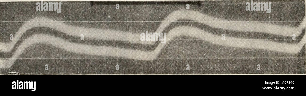. Fig. 425. Von Mesenterialarterie Puls. Nach C. Tigerstedt. Liens von nach rechts zu lesen. Mesenterialarterien tretenj Im Puls der die Wellen superponierten in der Regel nur ganz auf undeutlich, obgleich daselbst ab und zu, insbesondere nach Adrenalin, Andeutungen von vorkommen. Beim Kaninchen gibt die Form également des impulsions en den Gefäßen peripheren wesentlich die des zentralen légumineuses wieder ; nur das wird den systolische Gefäßen dans Plateau peripheren immer mehr absteigend und die für den zentralen Puls pour superponierten charakteristischen Wellen klingen allmählich ab. Effet ist ab Banque D'Images