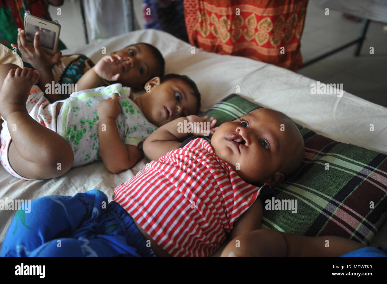 Défaut de naissance Bébé garçon avec harelip à Dhaka medical college de l'unité de gravure au Bangladesh. Banque D'Images