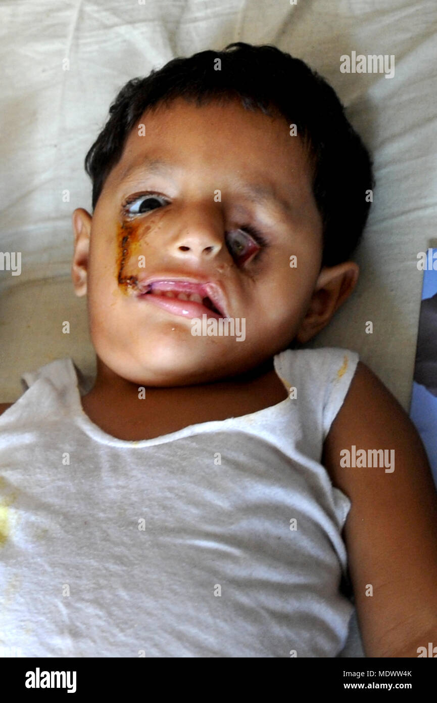 Defaut De Naissance Bebe Garcon Avec Harelip A Dhaka Medical College De L Unite De Gravure Au Bangladesh Photo Stock Alamy