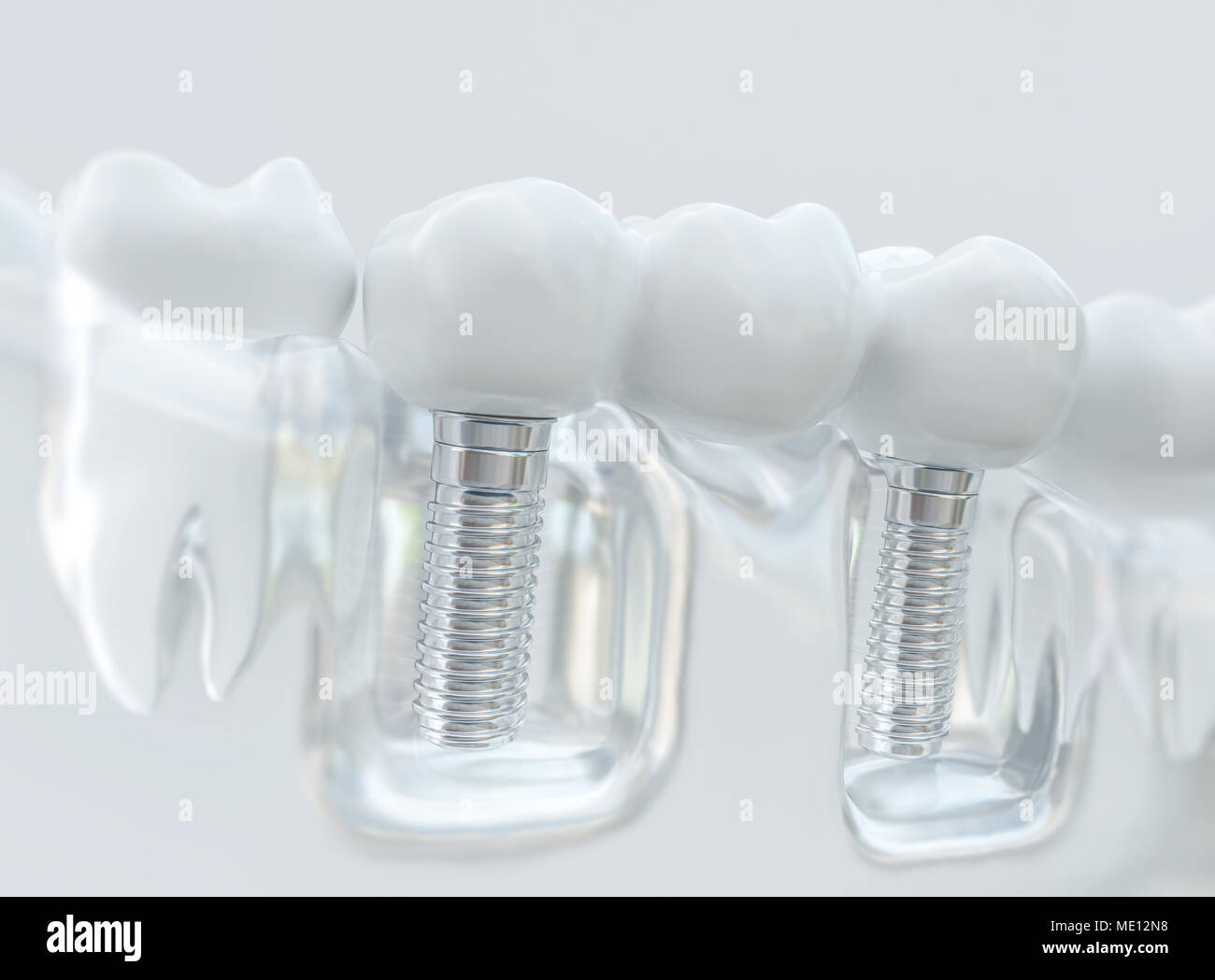 Les implants avec un bridge dentaire - 3D Rendering Banque D'Images