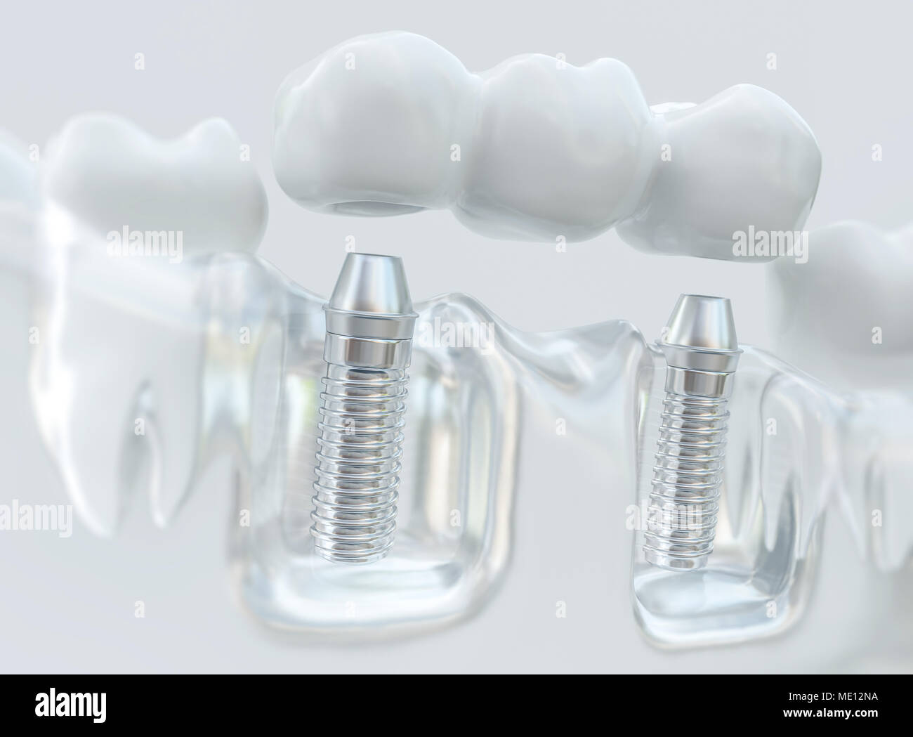 Les implants avec un bridge dentaire - 3D Rendering Banque D'Images