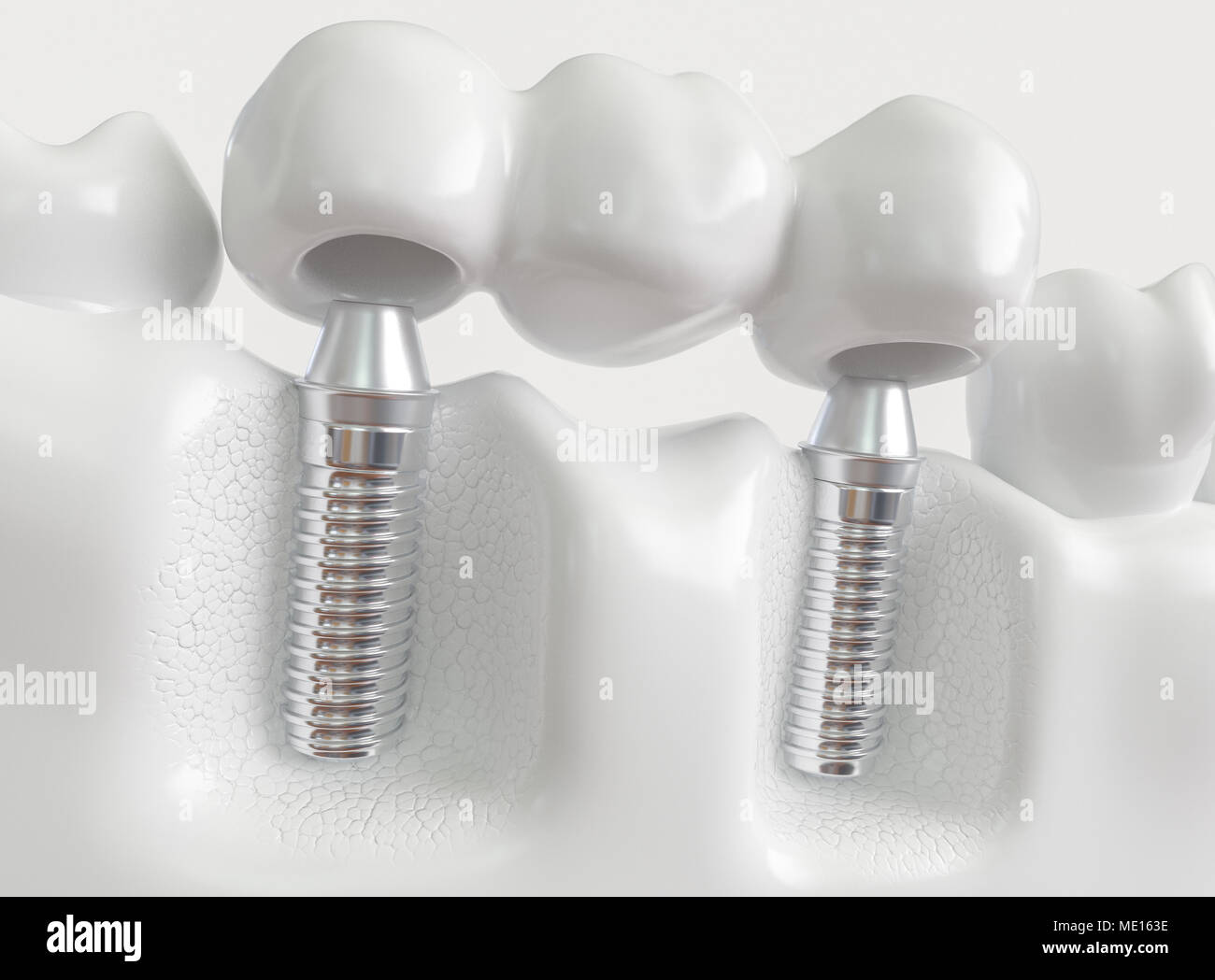 Les implants avec un bridge dentaire - 3D Rendering Banque D'Images