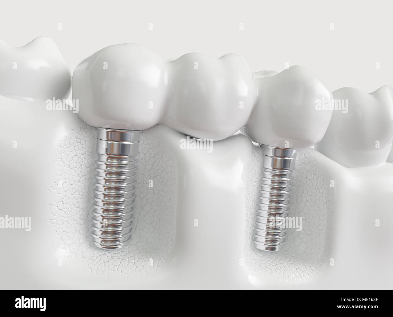 Les implants avec un bridge dentaire - 3D Rendering Banque D'Images