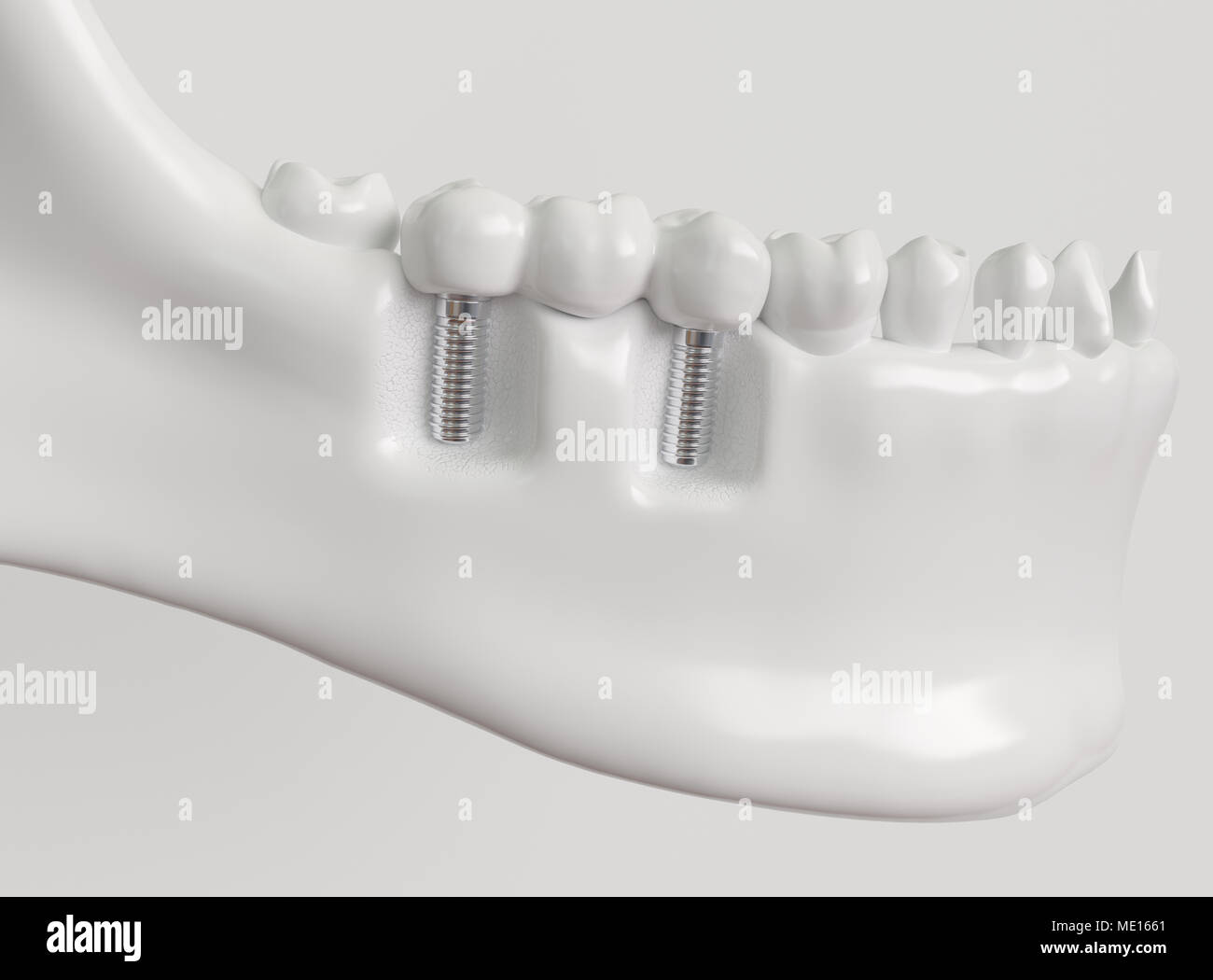 Les implants avec un bridge dentaire - 3D Rendering Banque D'Images