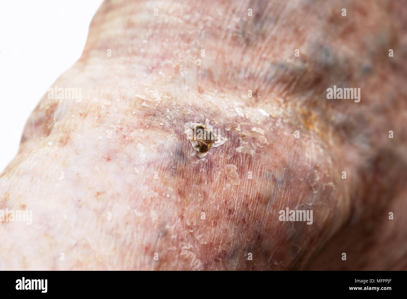 Un ulcère variqueux situé sur une varice modèle libération Banque D'Images