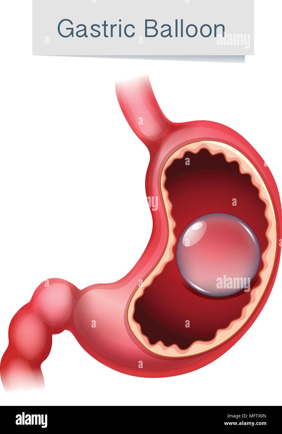 L'anatomie humaine illustration illustration Ballon Gastrique Illustration de Vecteur