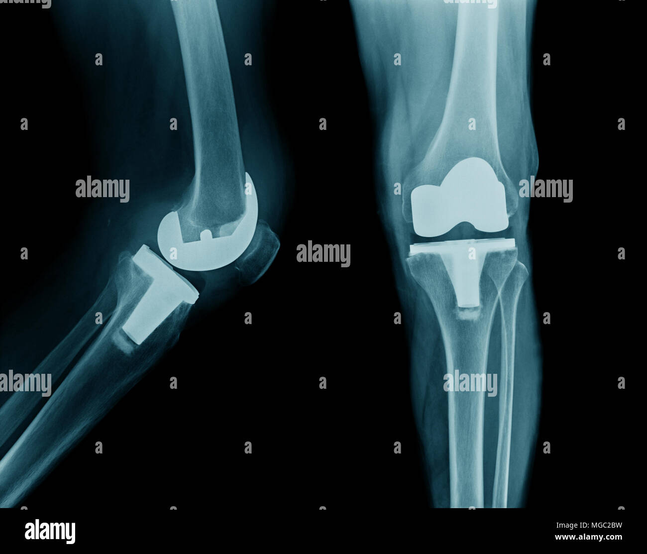 X-ray de la hanche ou du genou AP et vue latérale. Banque D'Images