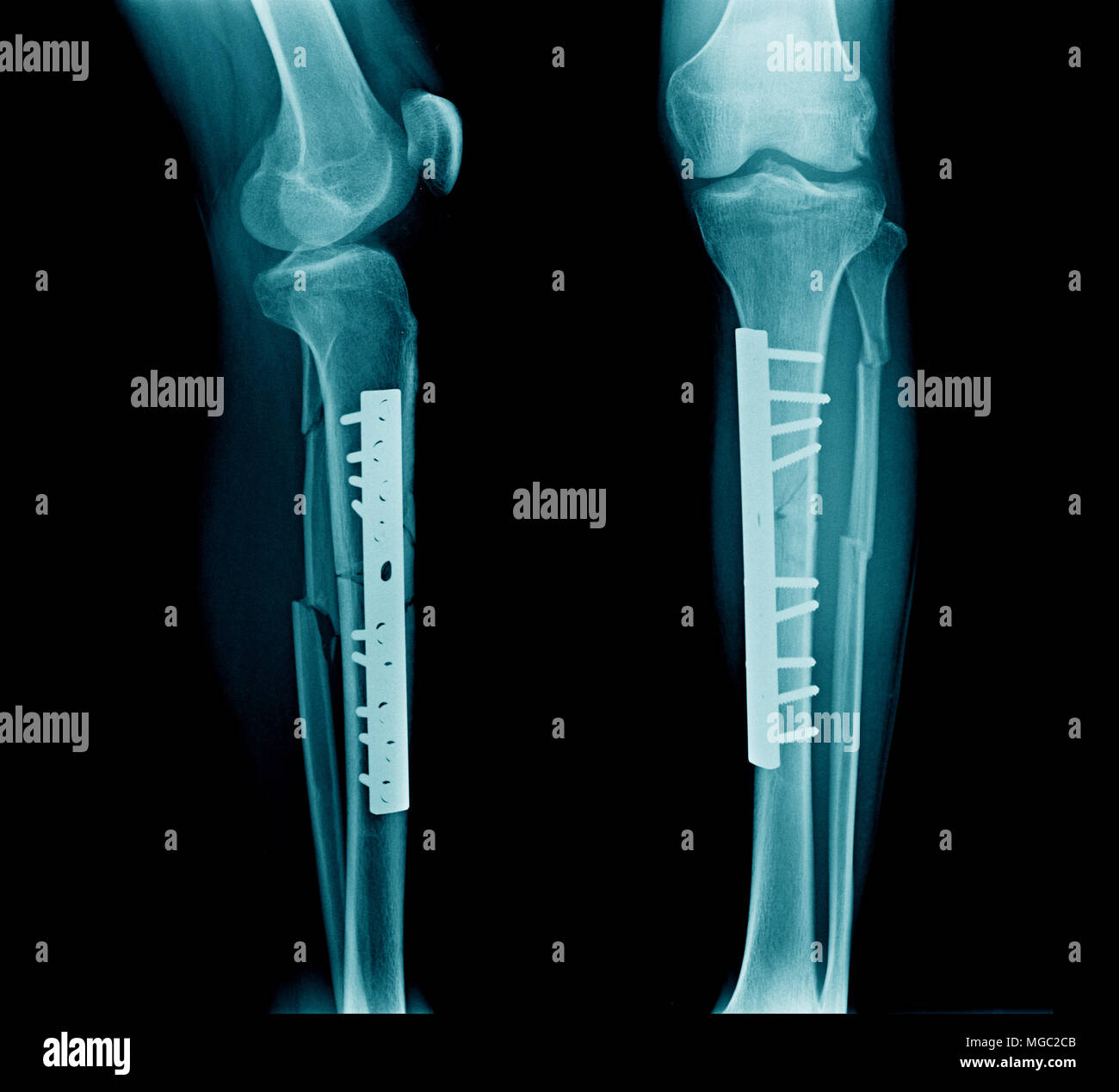 Les fractures des os de la jambe avec de l'os du tibia après fixation Banque D'Images