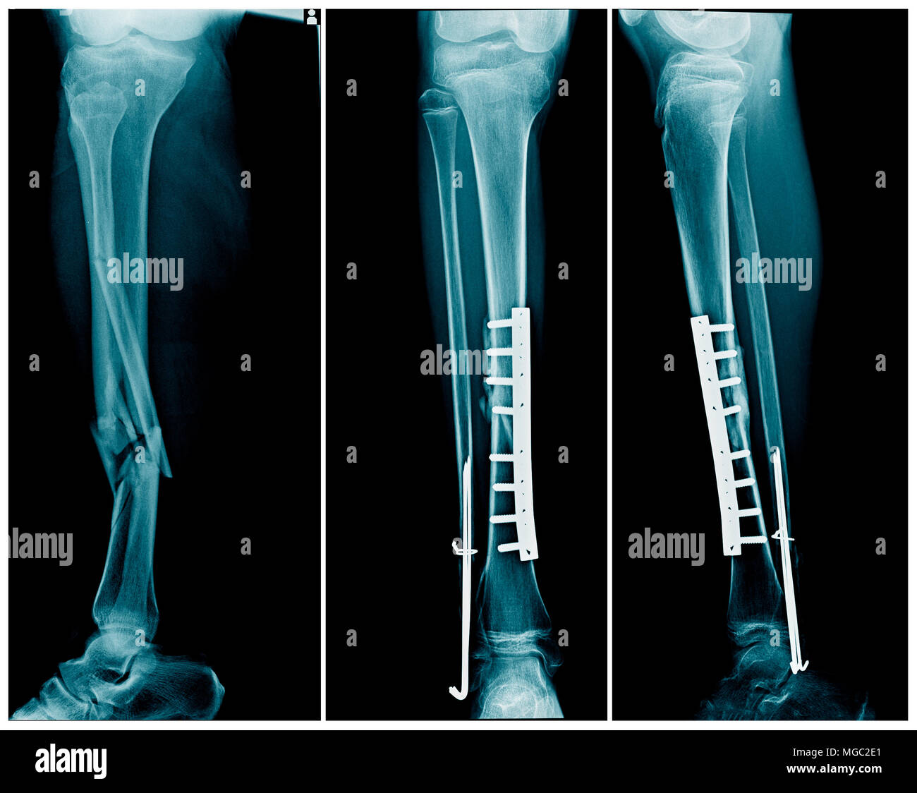 X-ray fracture de la jambe avec fixation interne après l'opération de l'os du tibia Banque D'Images