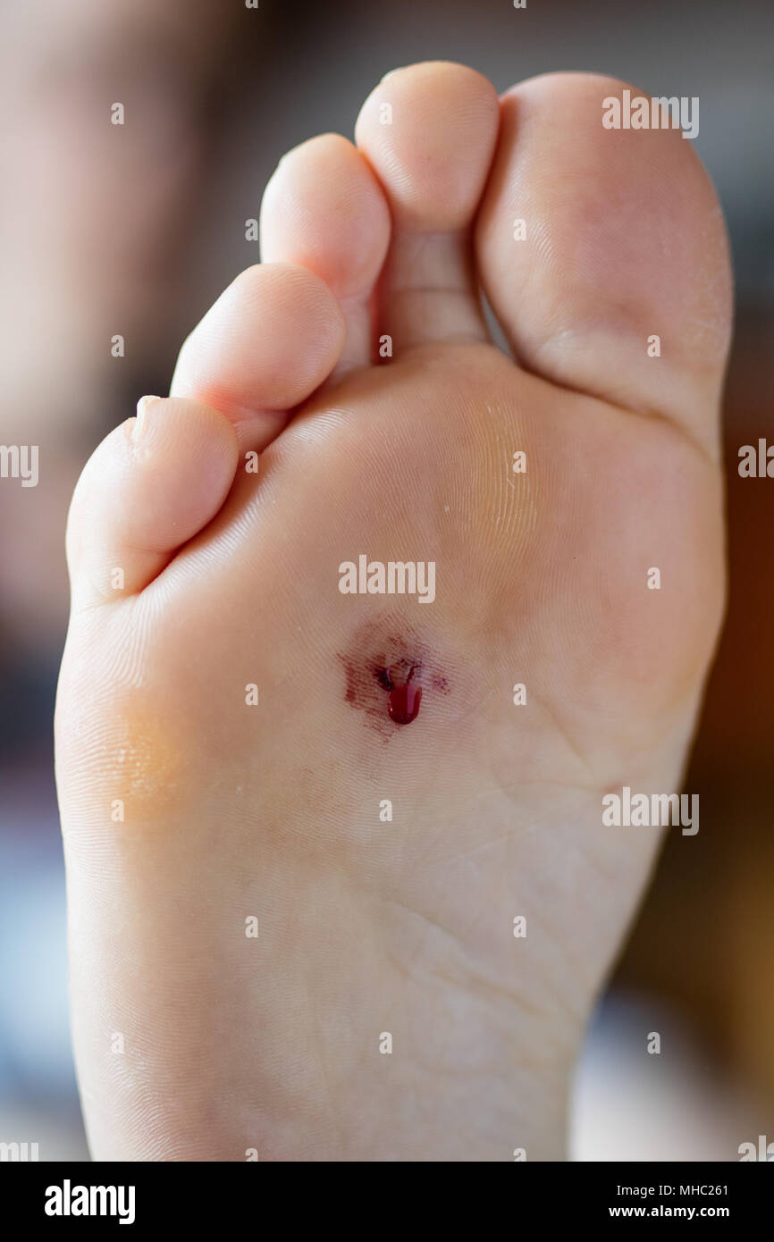 Blessé au pied féminin. Une blessure de l'ongle que percé la chaussure.  Fond clair Photo Stock - Alamy