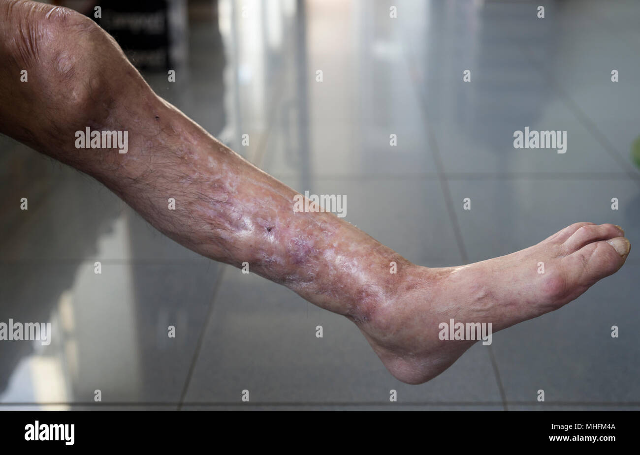 Psoriasis dans les pieds dans un état très grave, accident de la route. Banque D'Images