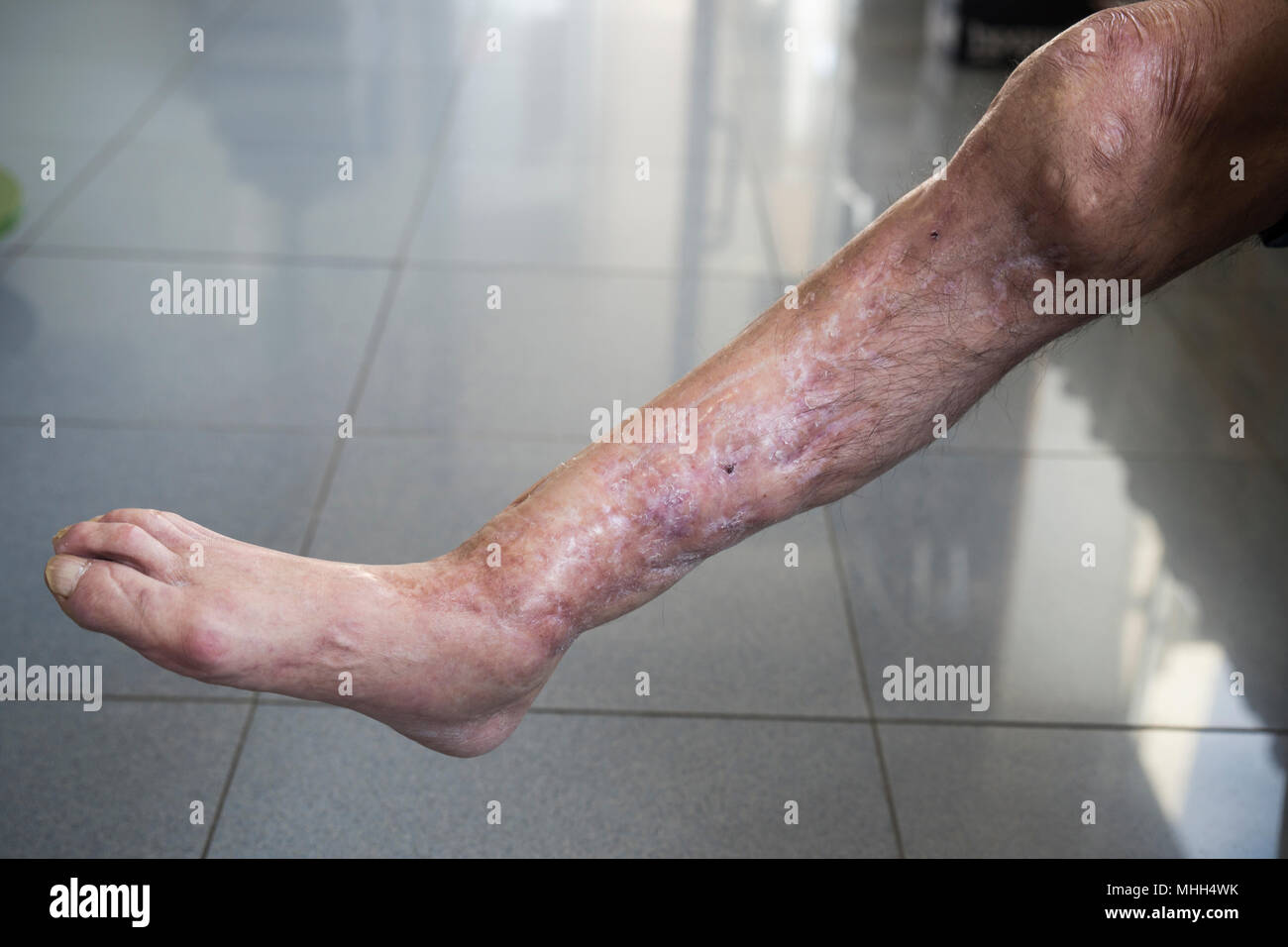 Psoriasis dans les pieds dans un état très grave, accident de la route. Banque D'Images