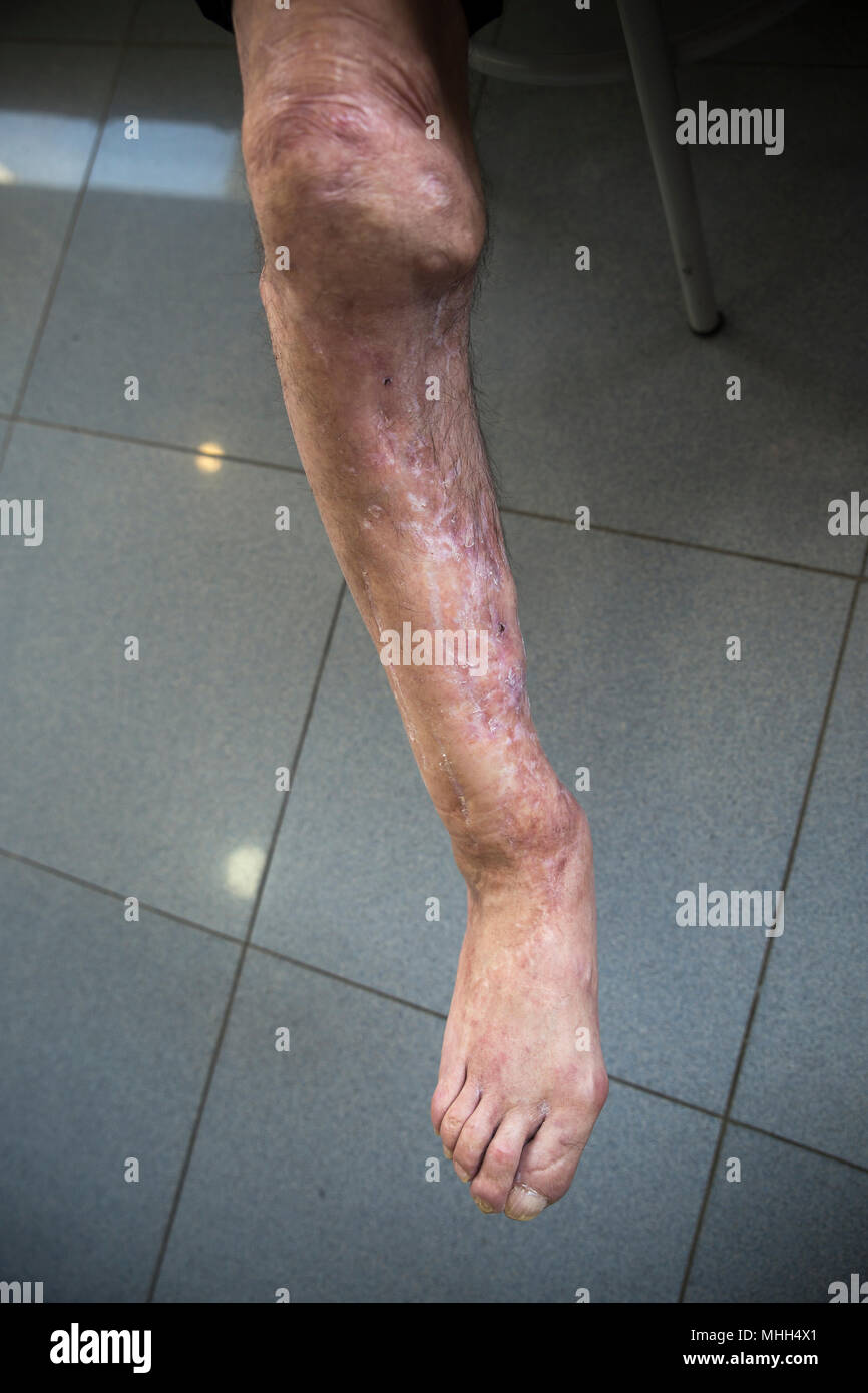 Psoriasis dans les pieds dans un état très grave, accident de la route. Banque D'Images