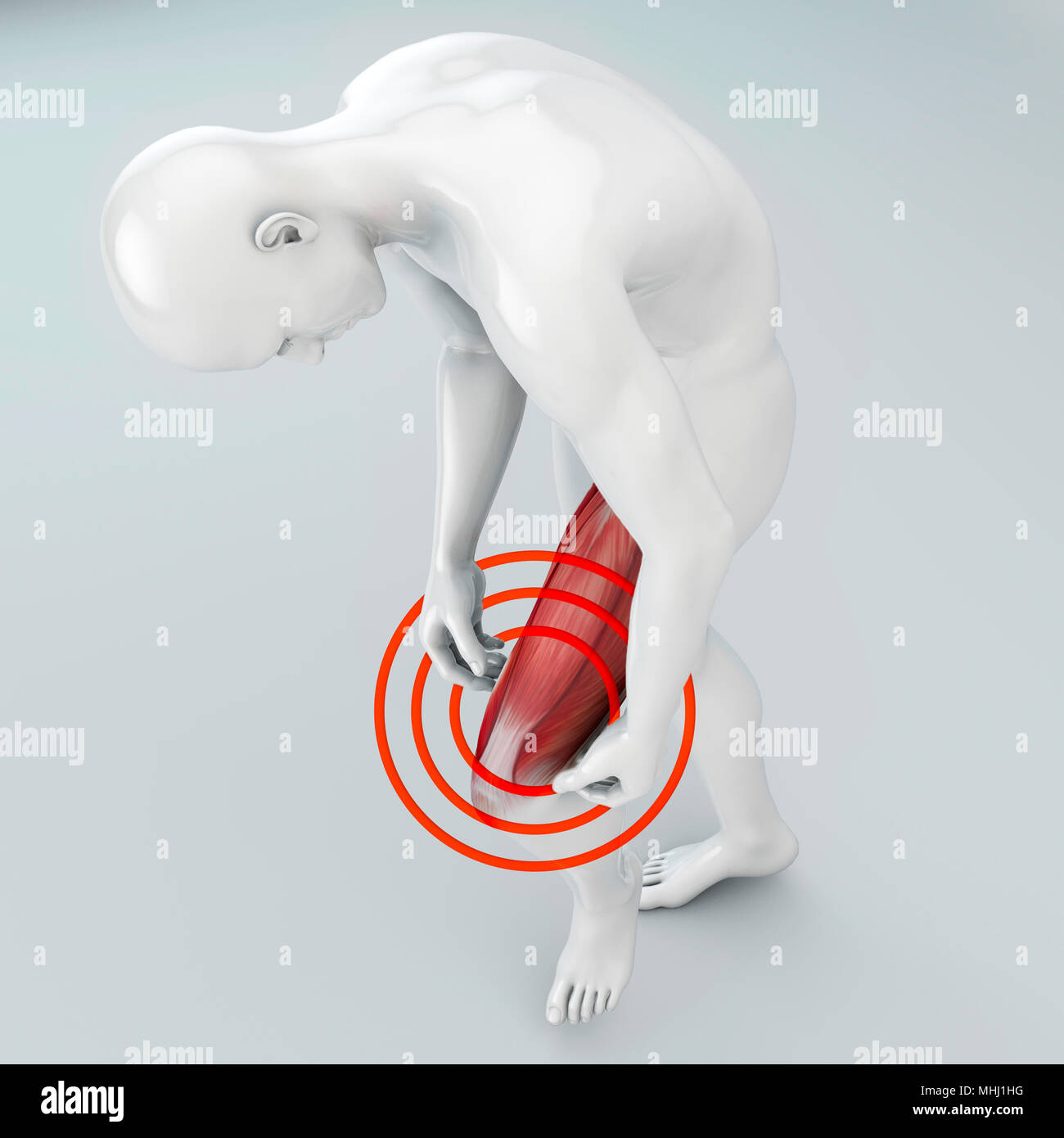 Déchirure musculaire les muscles des cuisses, au-dessus du genou. La douleur dans la jambe et les ligaments. Corps humain, rendu 3D Banque D'Images