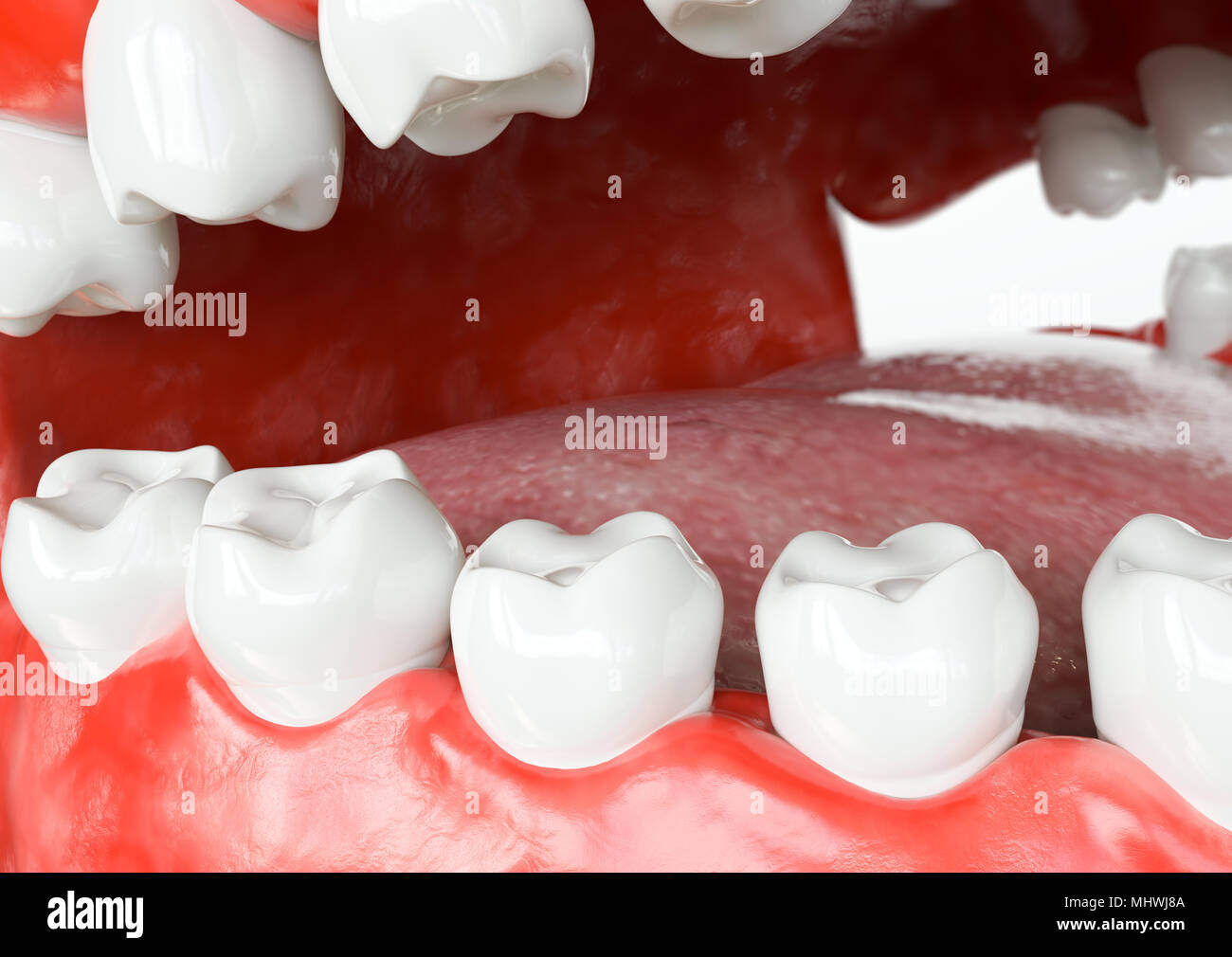 Des dents implant -après- le rendu 3D Banque D'Images