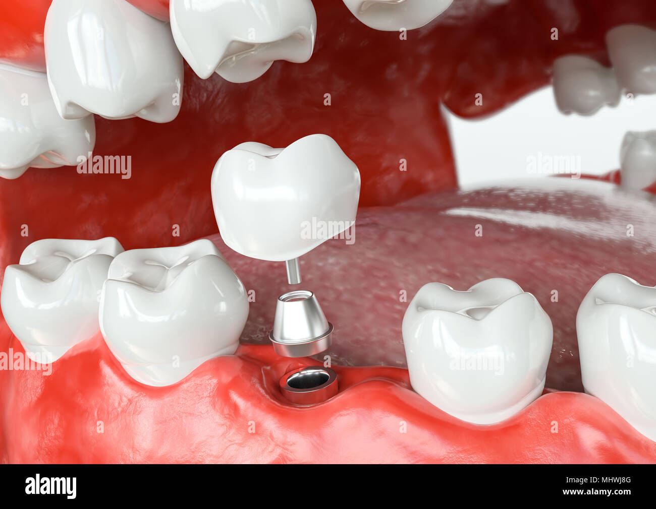 Des dents -implant avant - le rendu 3D Banque D'Images