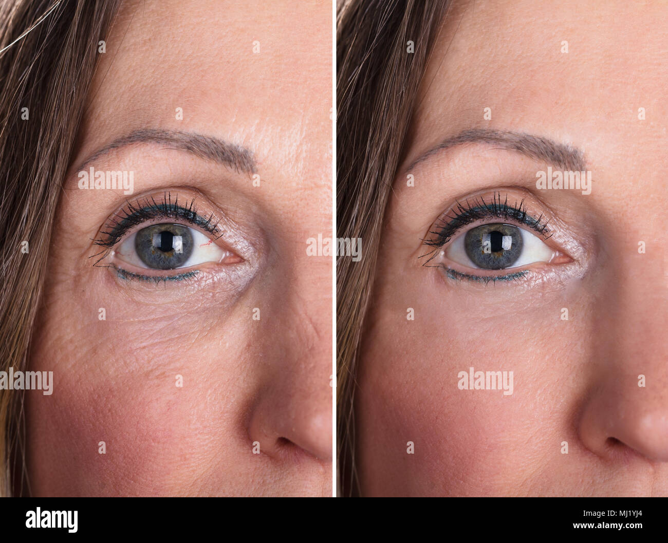 Photo de procédures anti-vieillissement sur Caucasian Woman Face Banque D'Images