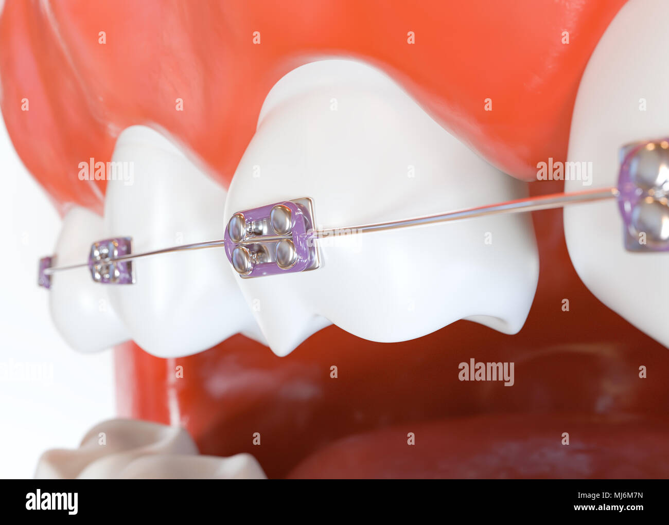 Dents avec accolades ou crochets à ouvrir la bouche de l'homme - le rendu 3D Banque D'Images