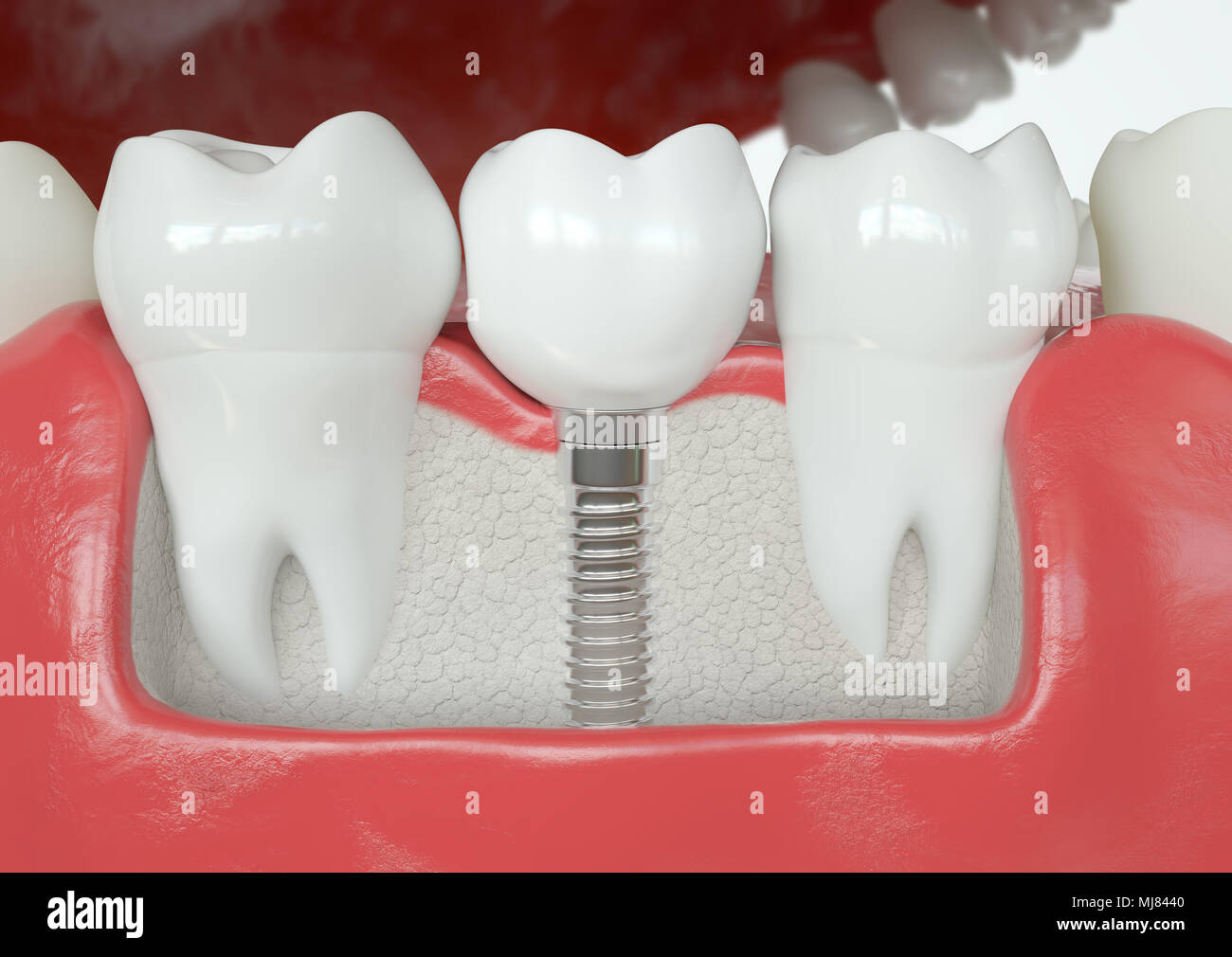 Vs sain implant - le rendu 3D Banque D'Images