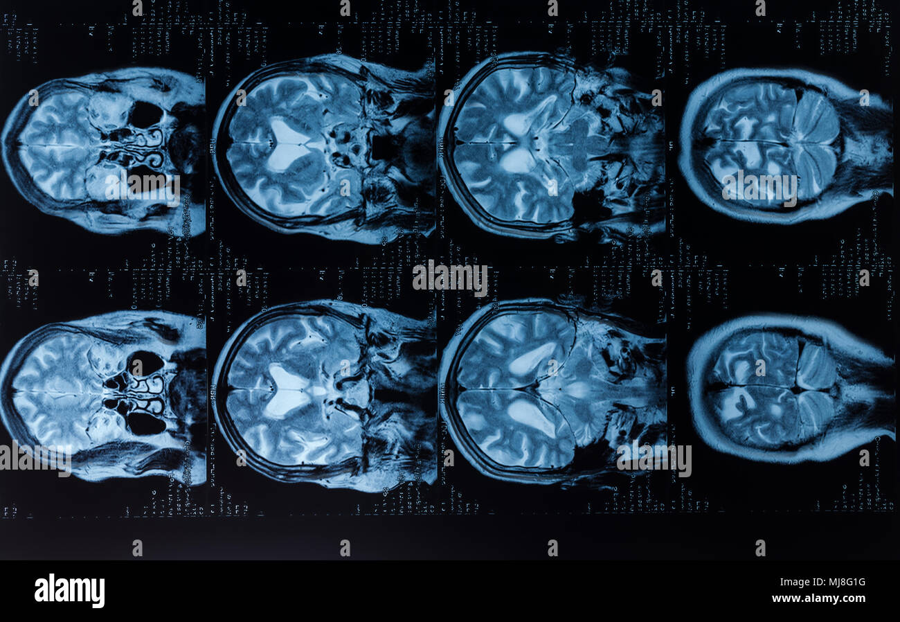 Chef MRT. Image IRM de cerveau humain Banque D'Images