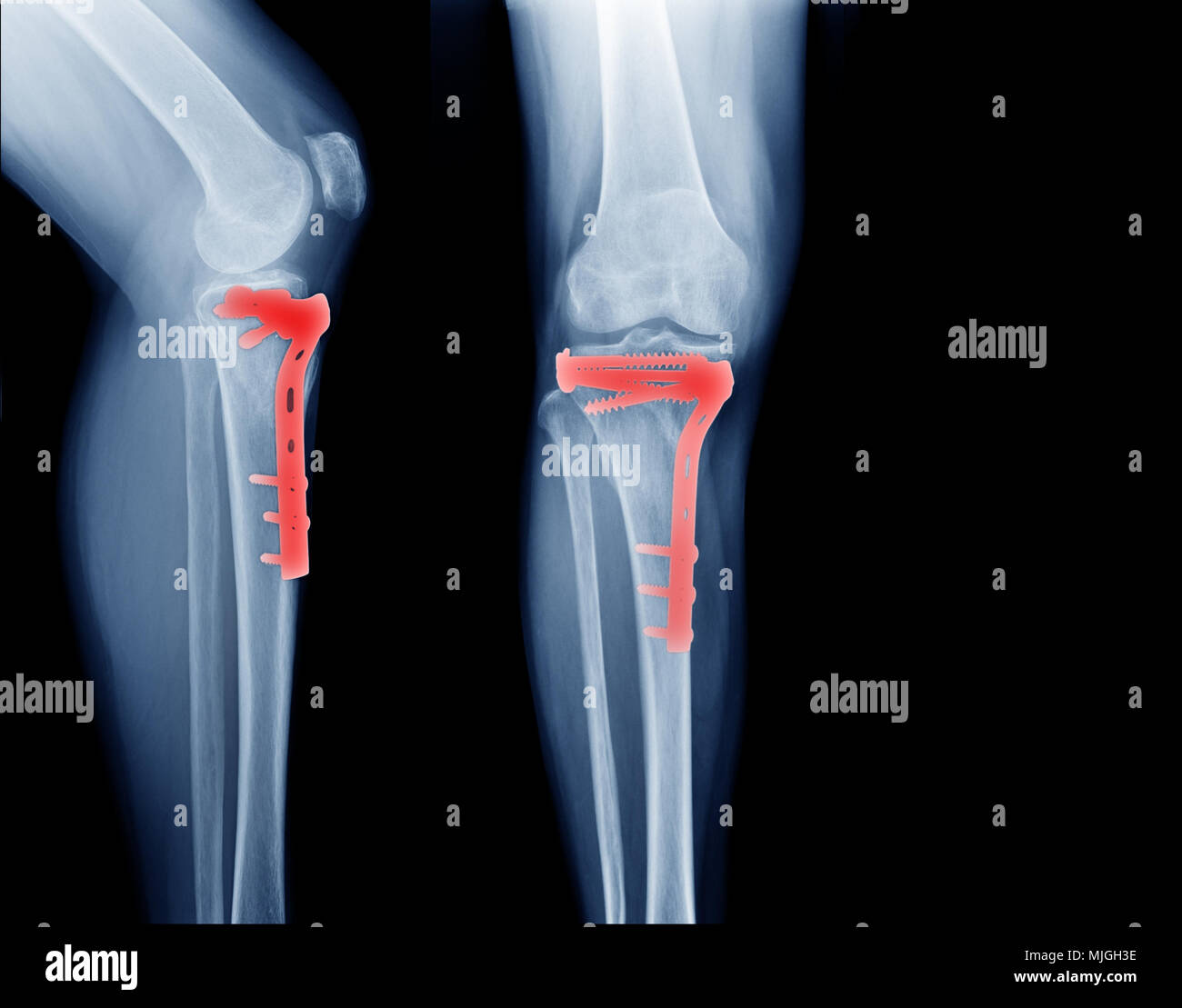 L'os du tibia fracture et opération post antérieur et fixation latérale ( x-ray Banque D'Images