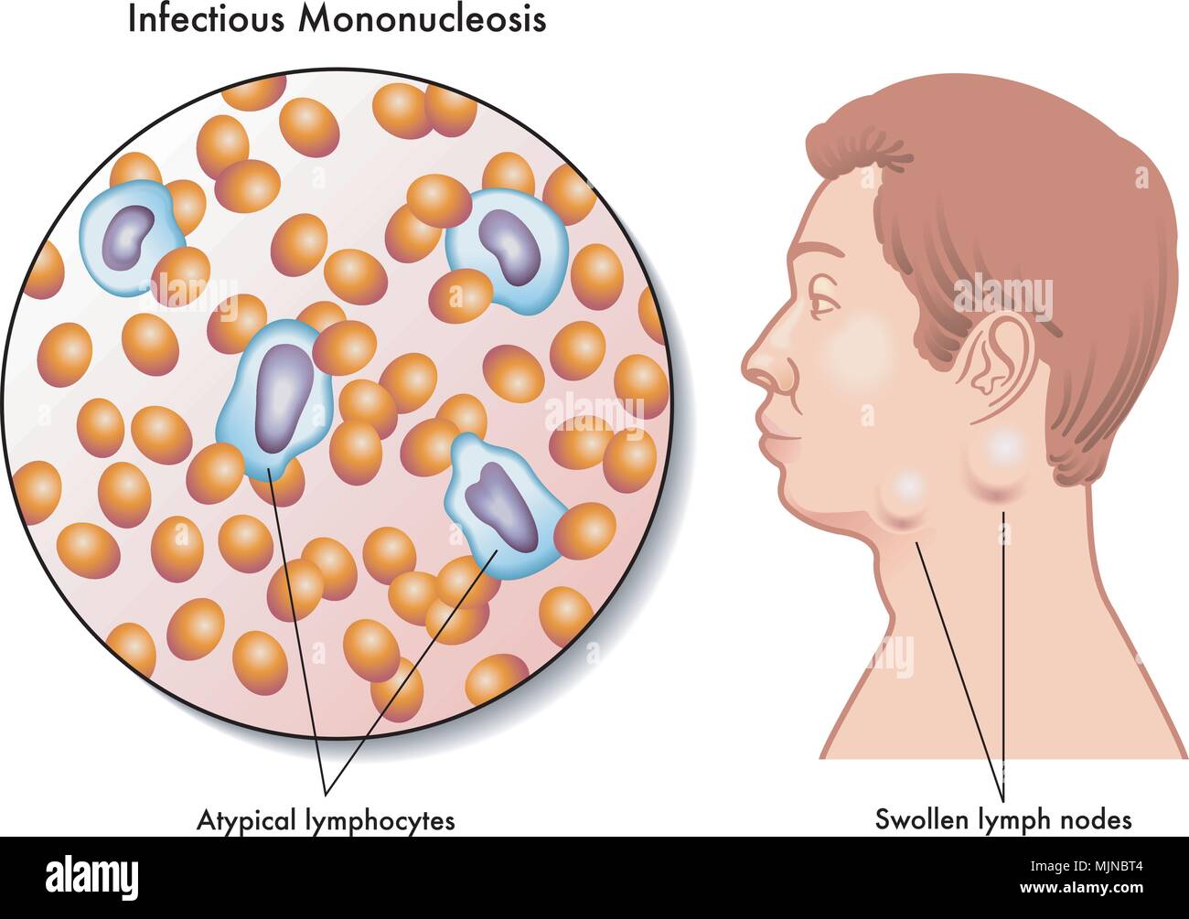 Vector illustration médicale des symptômes de la mononucléose infectieuse Illustration de Vecteur