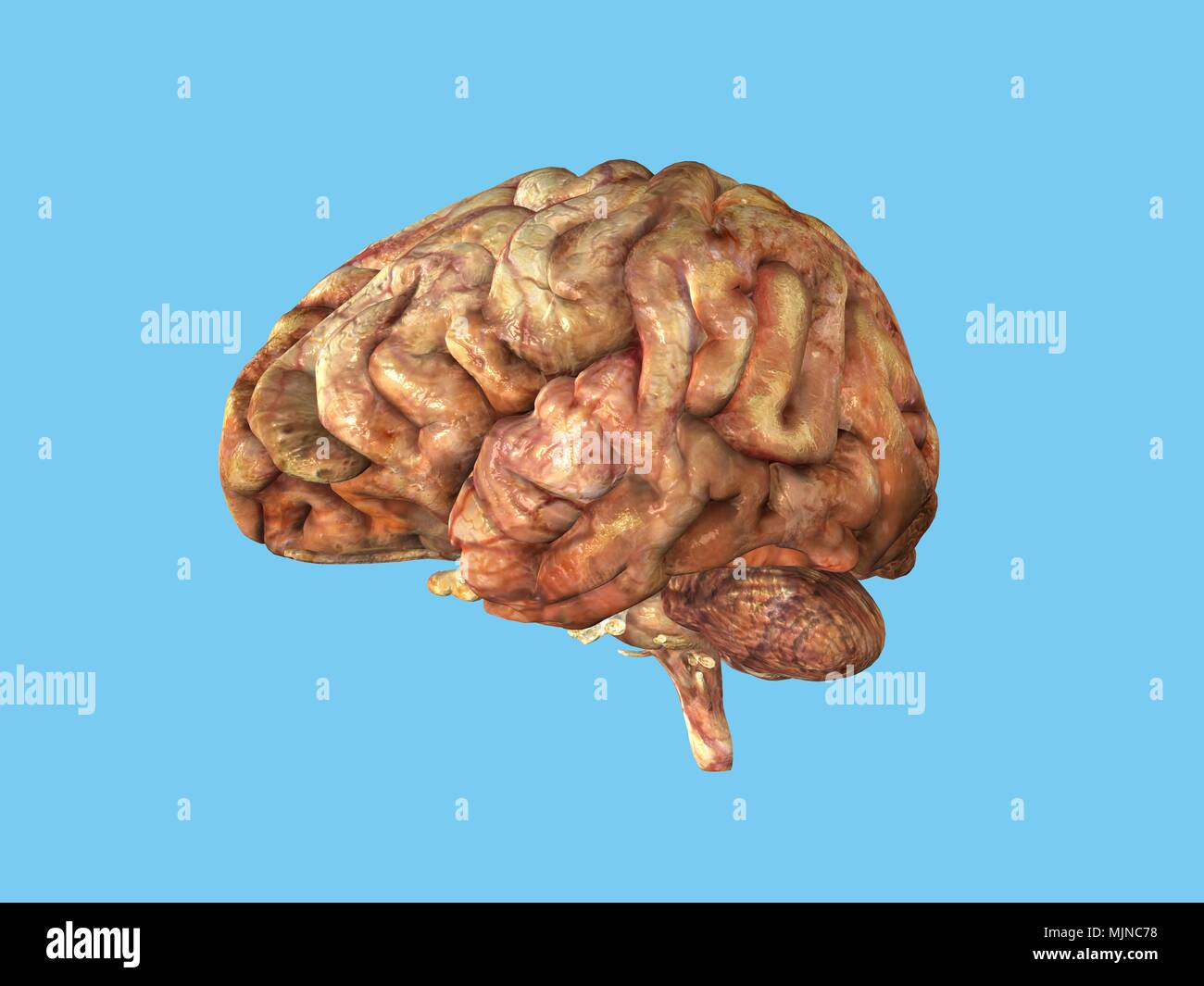 Cerveau humain -La santé compromise Banque D'Images