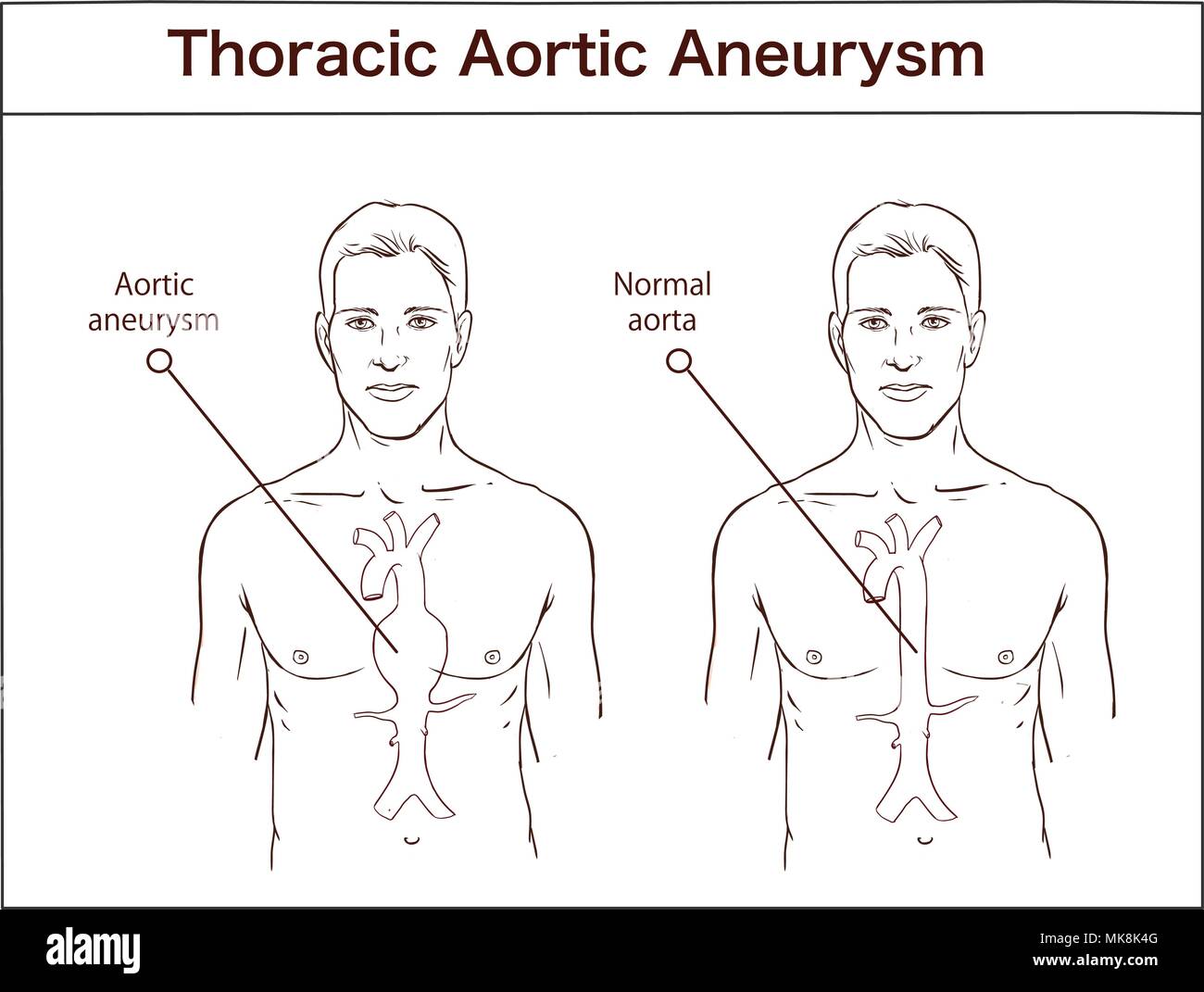 Types de l'anévrisme de l'aorte aorte normale. et élargi les navires. Diagramme vectoriel Illustration de Vecteur