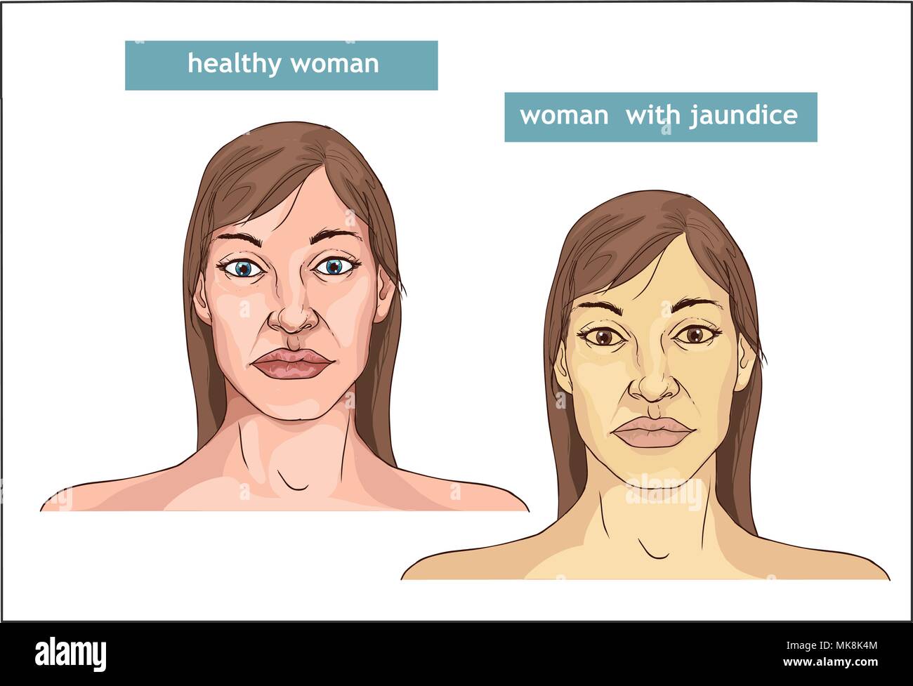 La comparaison entre la peau normale et le jaunissement de la Jaunisse Illustration de Vecteur