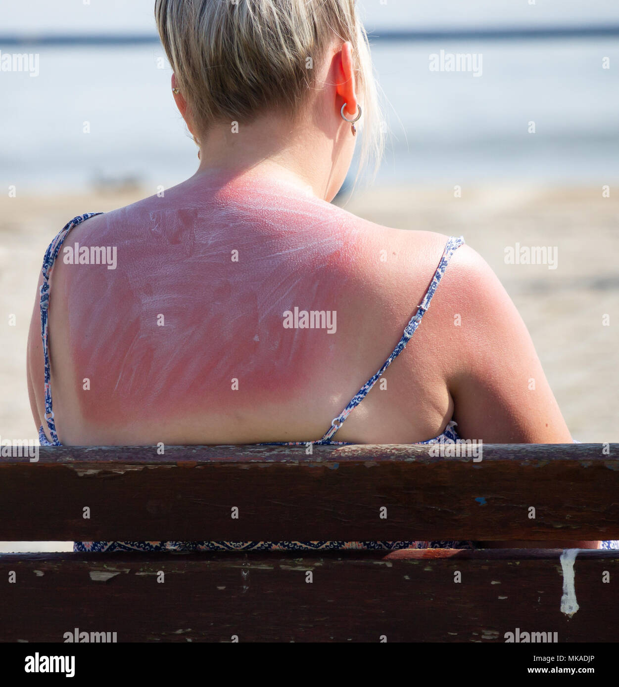 Femme avec coups de soleil pendant la vague de chaleur. Banque D'Images