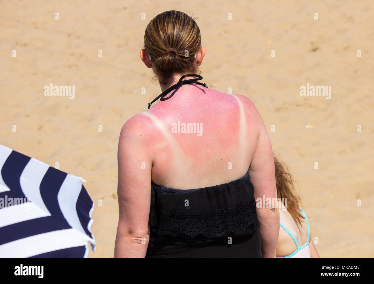 Femme avec un coup de soleil, coup de soleil, coup de soleil au retour. UK Banque D'Images