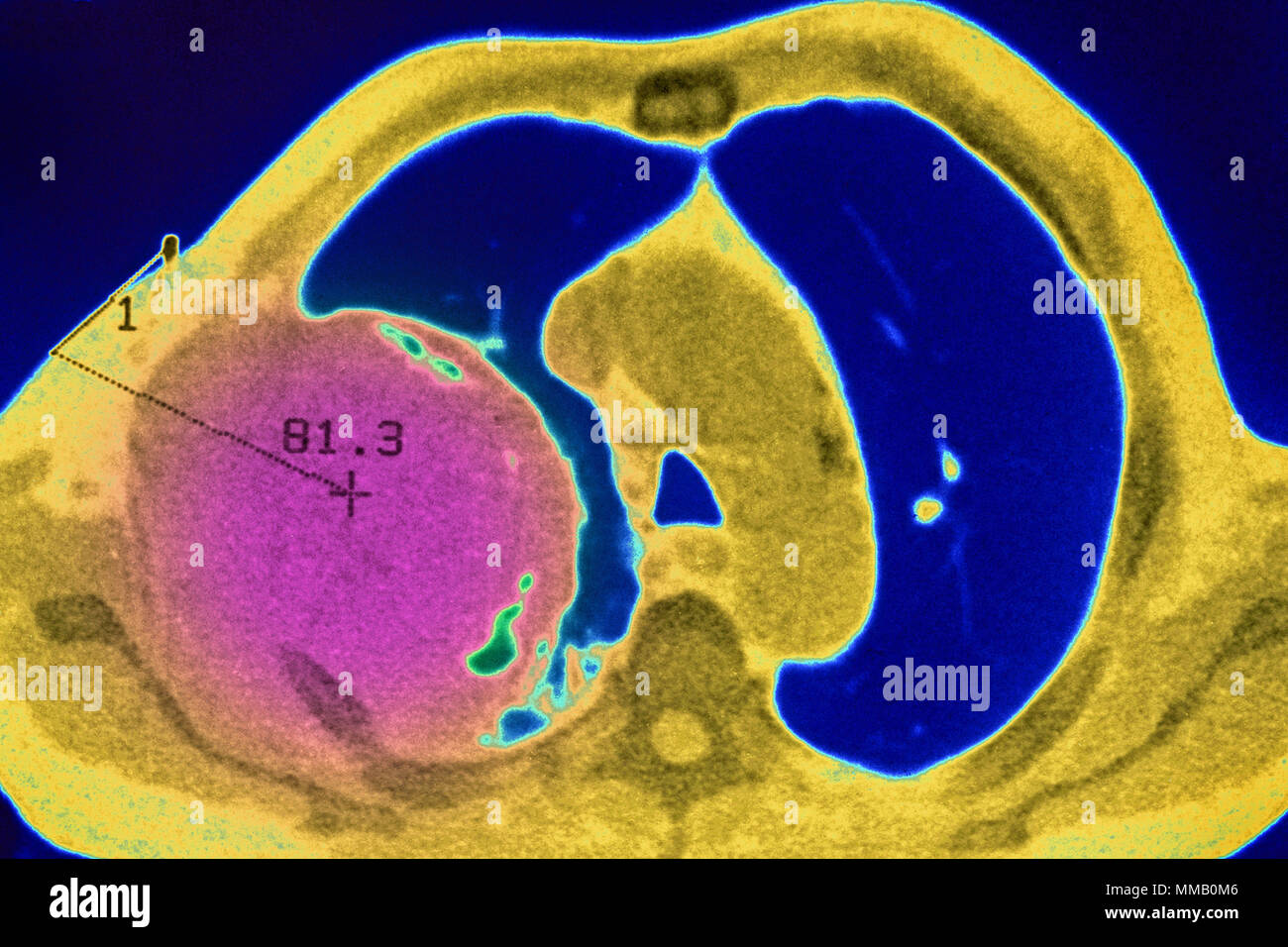 Le CANCER DU POUMON, CT SCAN Banque D'Images