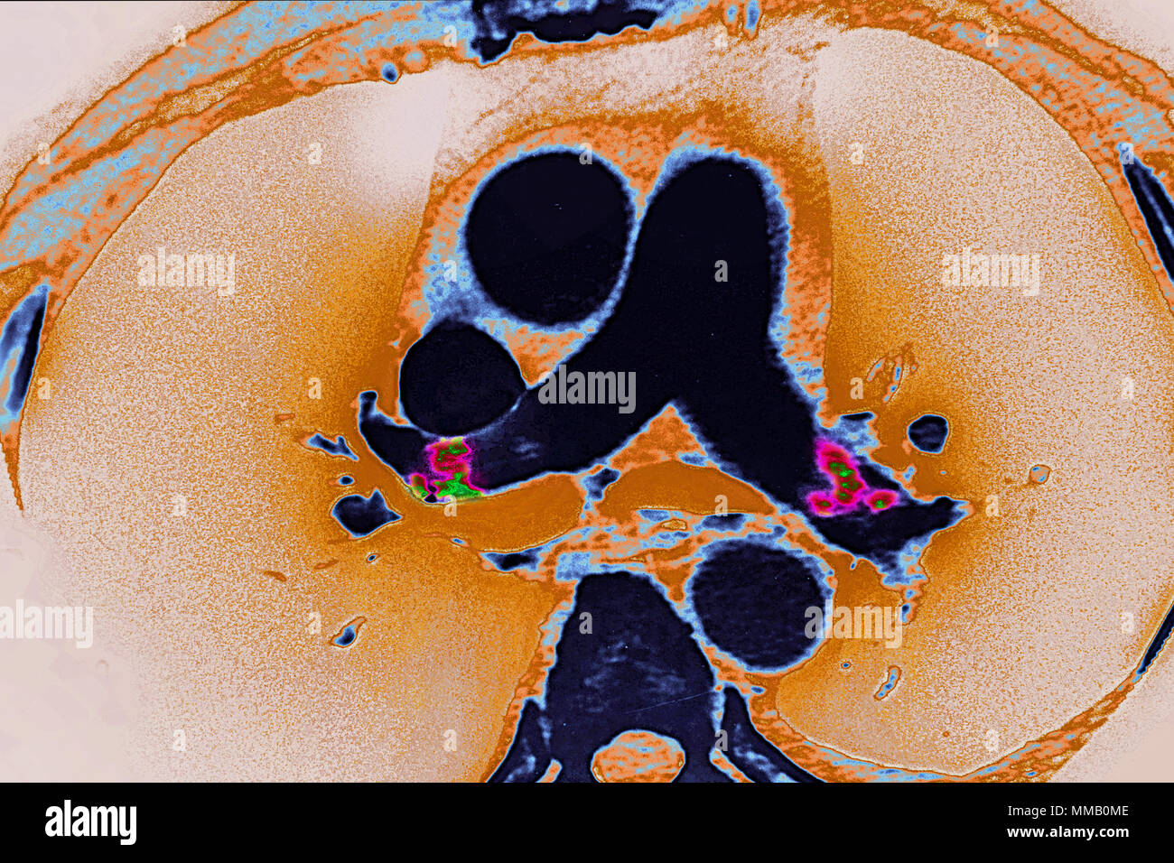 L'embolie pulmonaire, SCANNER Banque D'Images