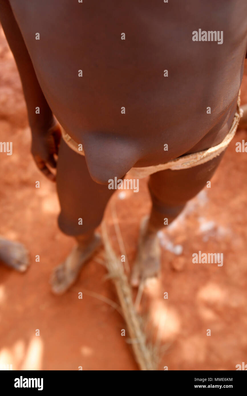 Enfant Africain avec un cordon ombilical hiatus. Banque D'Images