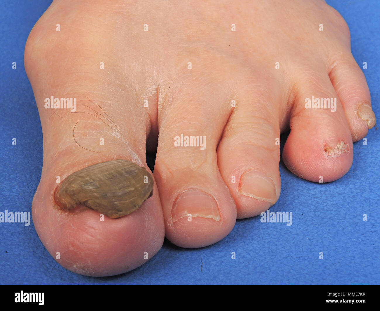 Ongle Incarné Banque d'image et photos Alamy