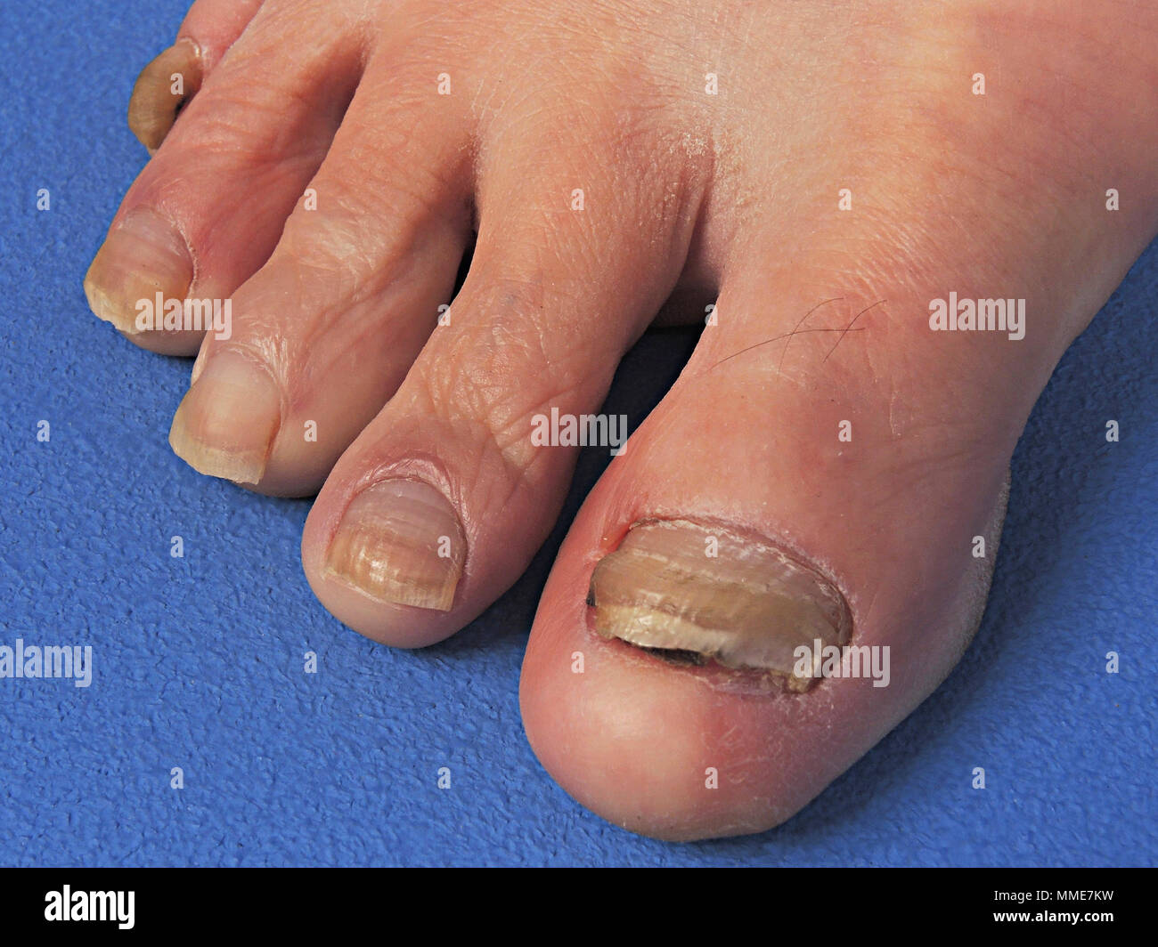 Ongle Incarne Photo Stock Alamy