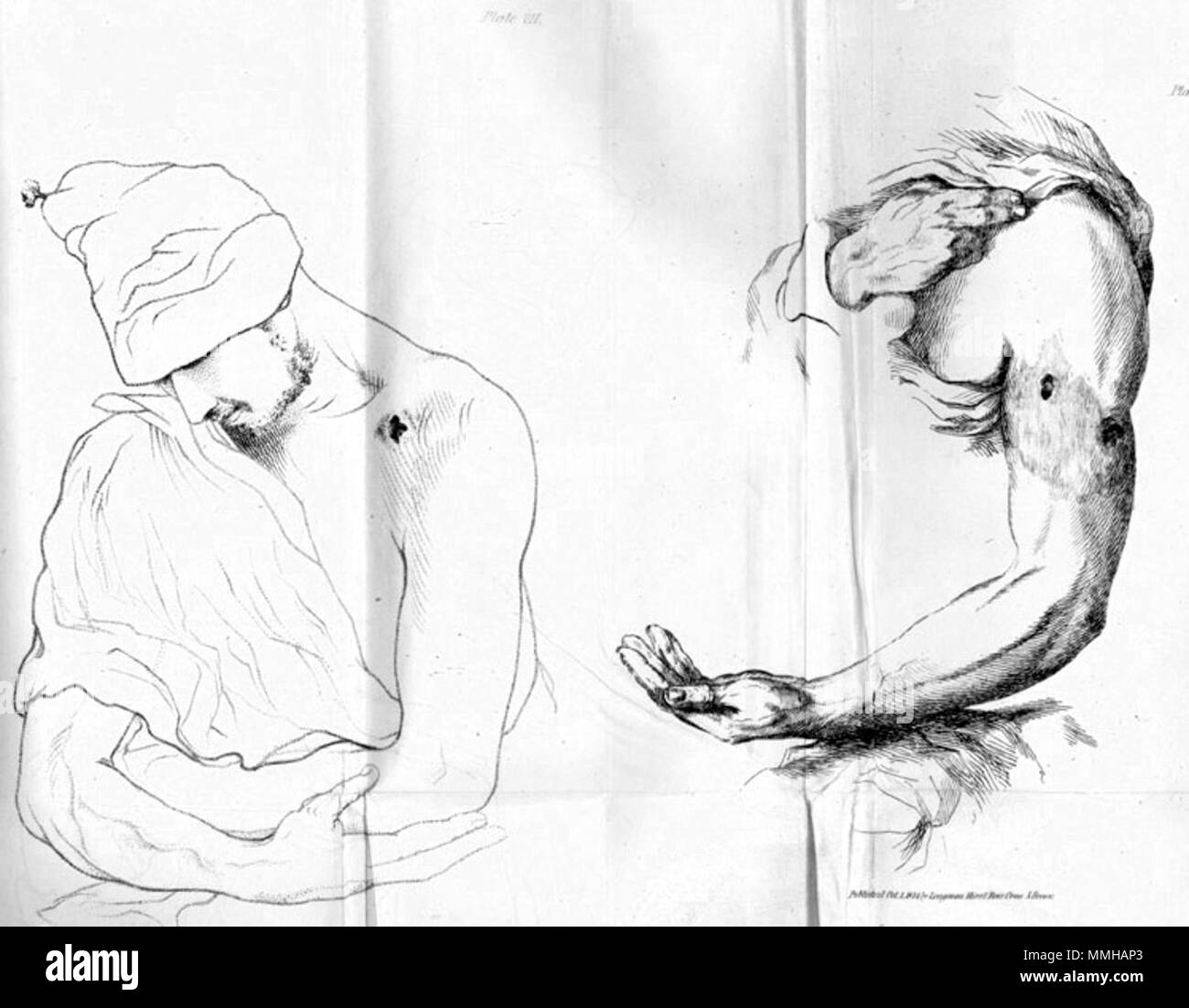 . Charles Bell (1774-1842) : un système de chirurgie opératoire, fondé sur la base de l'anatomie. London : Longman, Hurst, Rees, Orme, et Brown, 1814. . Janvier 2008. McLeod 79 blessures par Bell Banque D'Images