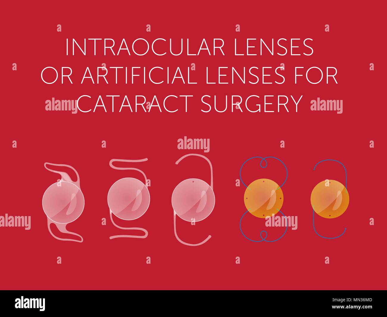 Schéma de types de lentille artificielle de l'oeil sur fond rouge Illustration de Vecteur