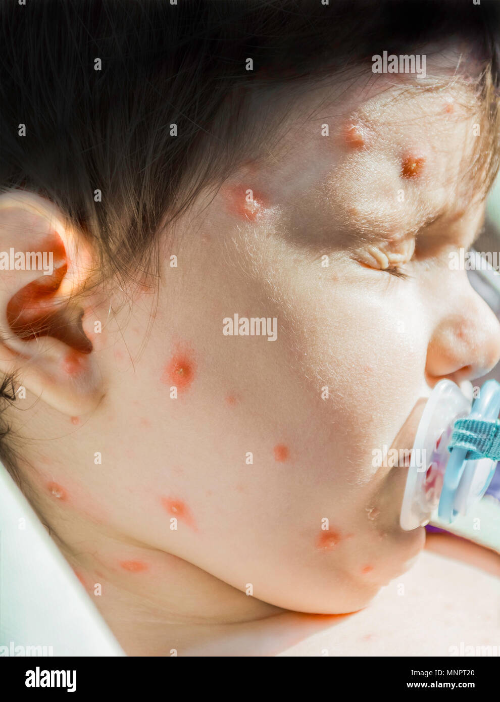 Gros plan du virus de la varicelle La varicelle ou éruption vésiculeuse et bulle sur visage de bébés avec la croûte. Concept de dermatologie. Banque D'Images