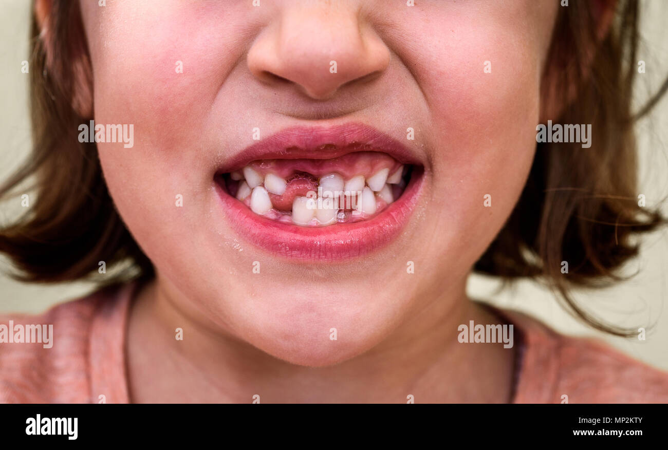 Portrait de jeune fille enfant sans dents de lait manquantes et les dents permanentes. Gros plan du jeune garçon avec des dents de plus en plus des lacunes et des dents permanentes et des gencives saines p Banque D'Images