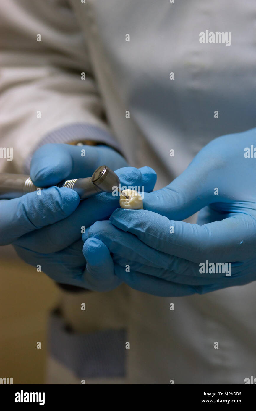 Chirurgien-dentiste dents prothétiques de moulage à l'aide d'une fraise dentaire et burr Banque D'Images