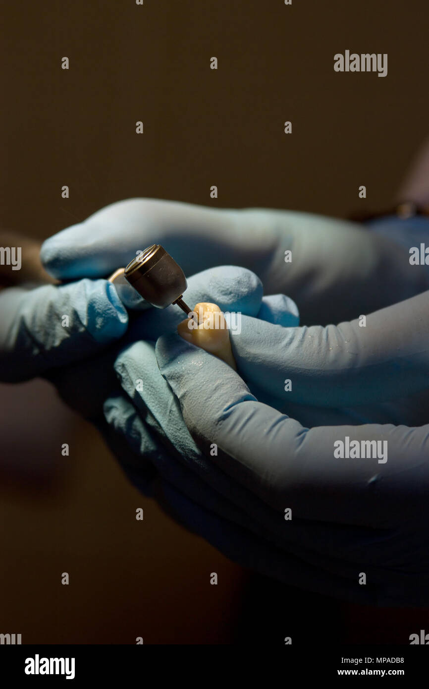 Chirurgien-dentiste dents prothétiques de moulage à l'aide d'une fraise dentaire et burr Banque D'Images