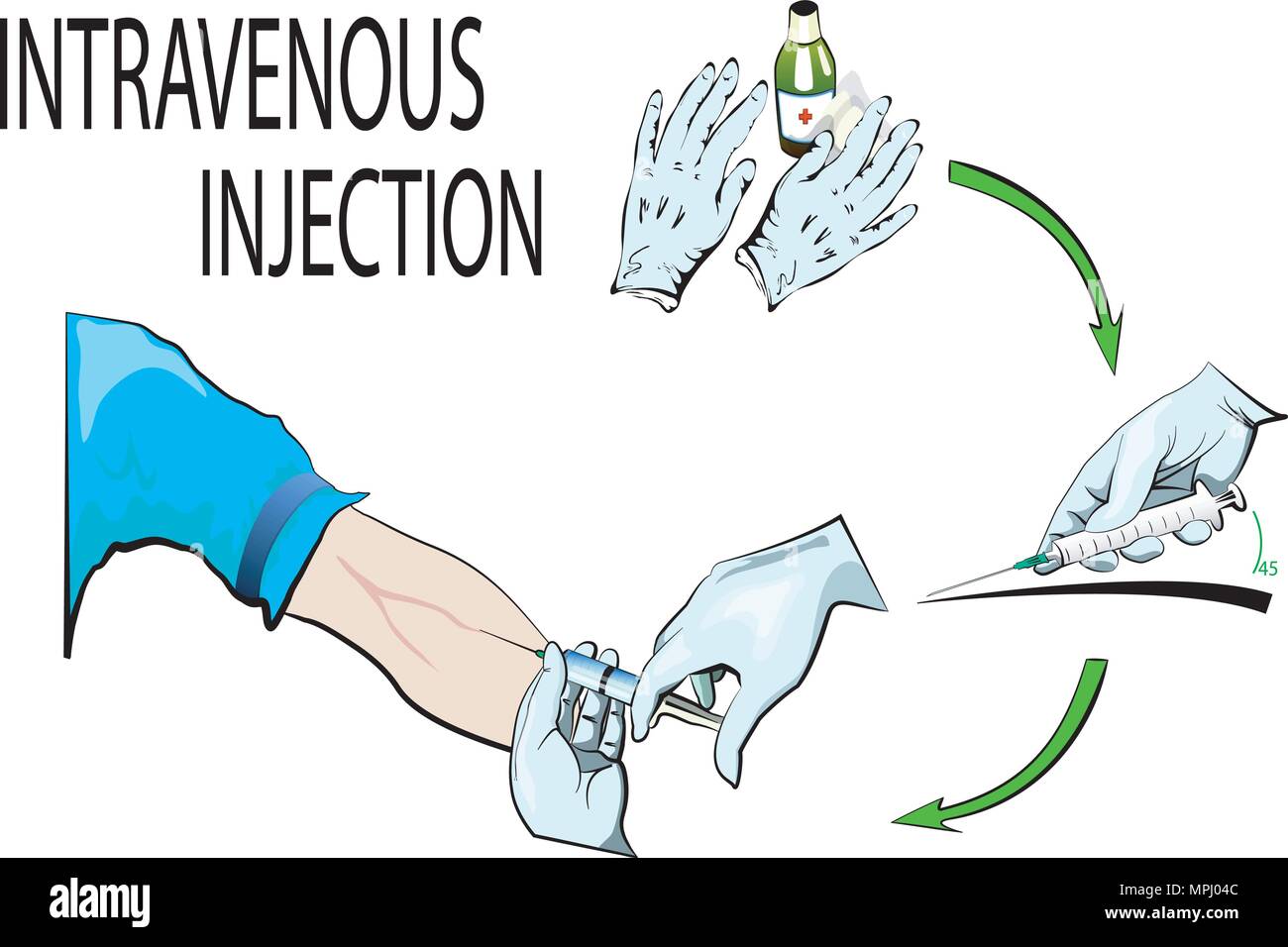 Illustration de gants médicaux, d'alcool et d'une seringue. Description L'injection intraveineuse. Illustration de Vecteur