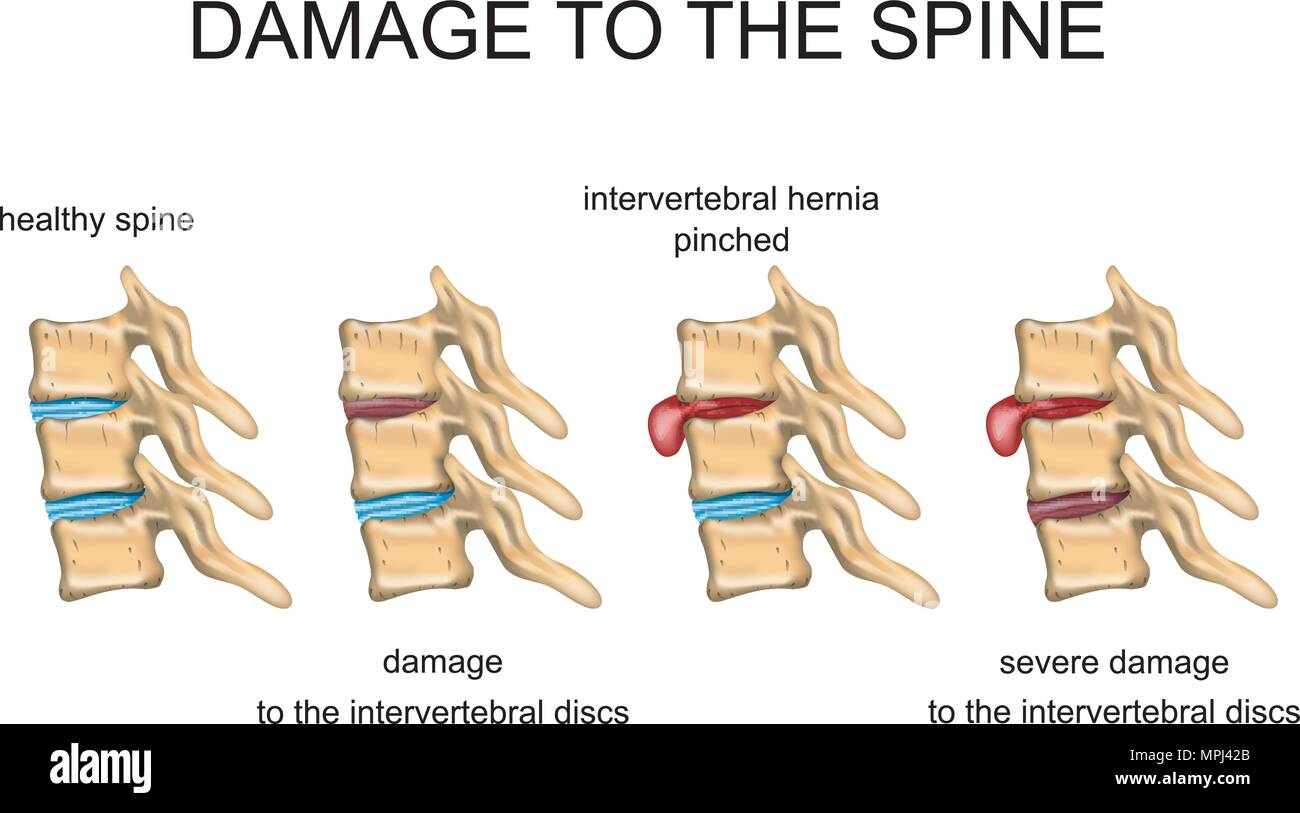 ILLUSTRATION D'un disque intervertébral sain, le disque intervertébral endommagé, hernie discale. Illustration de Vecteur