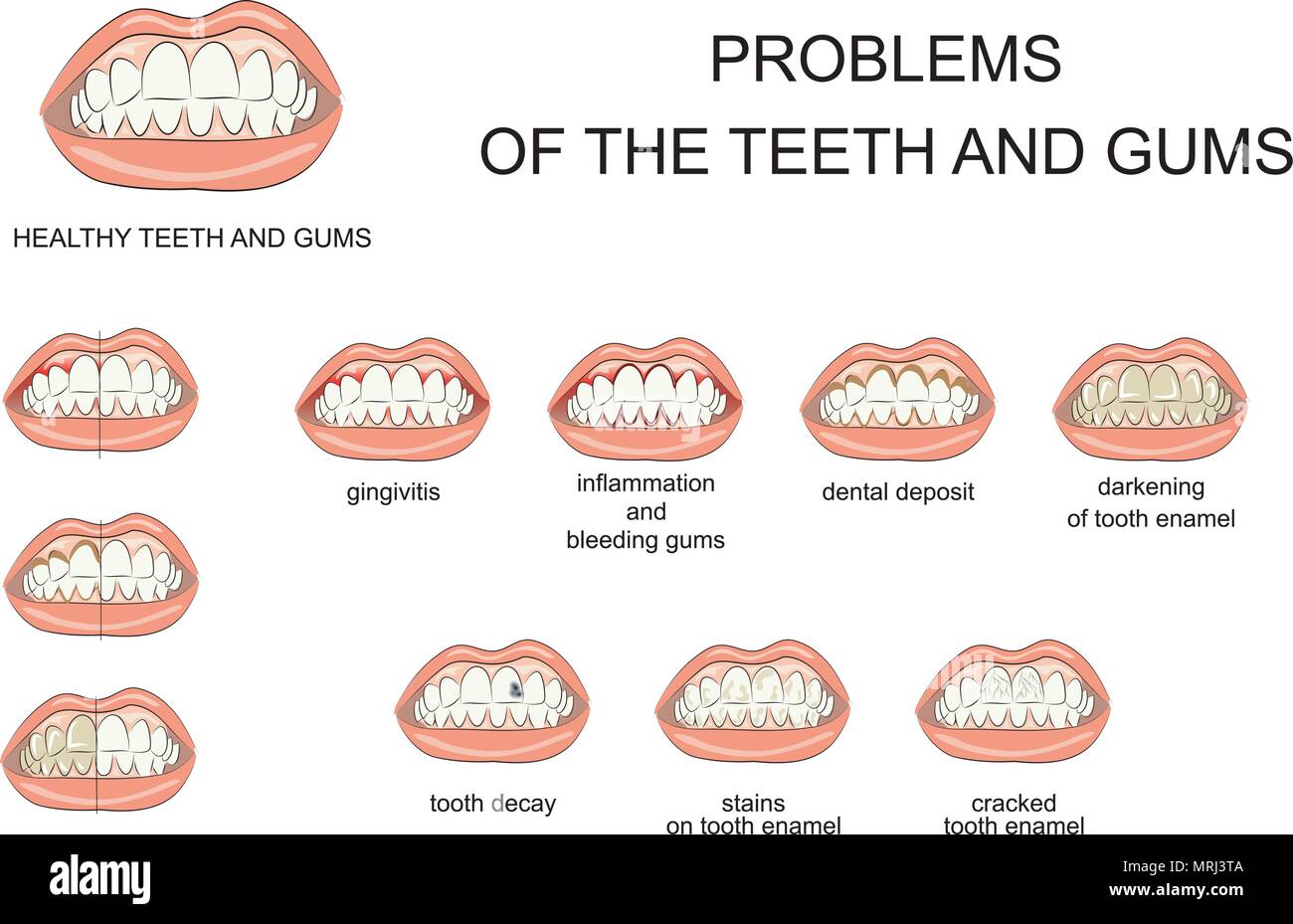 Illustration de la santé des gencives et des dents et les maladies de la cavité orale Illustration de Vecteur